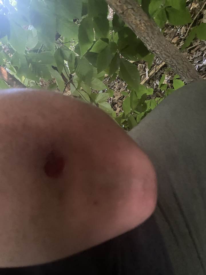 My son got bite by something during a hike on Monday. It wasn't