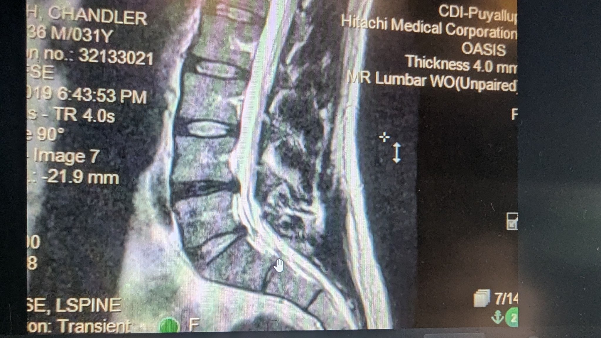 bpc-157 redit S1/L5 Herniated Disc / Spine Problems Wolverine Blend 20mg (BPC-157 Liquid Vitamin B12 Format:Pen 10mg/10mg
