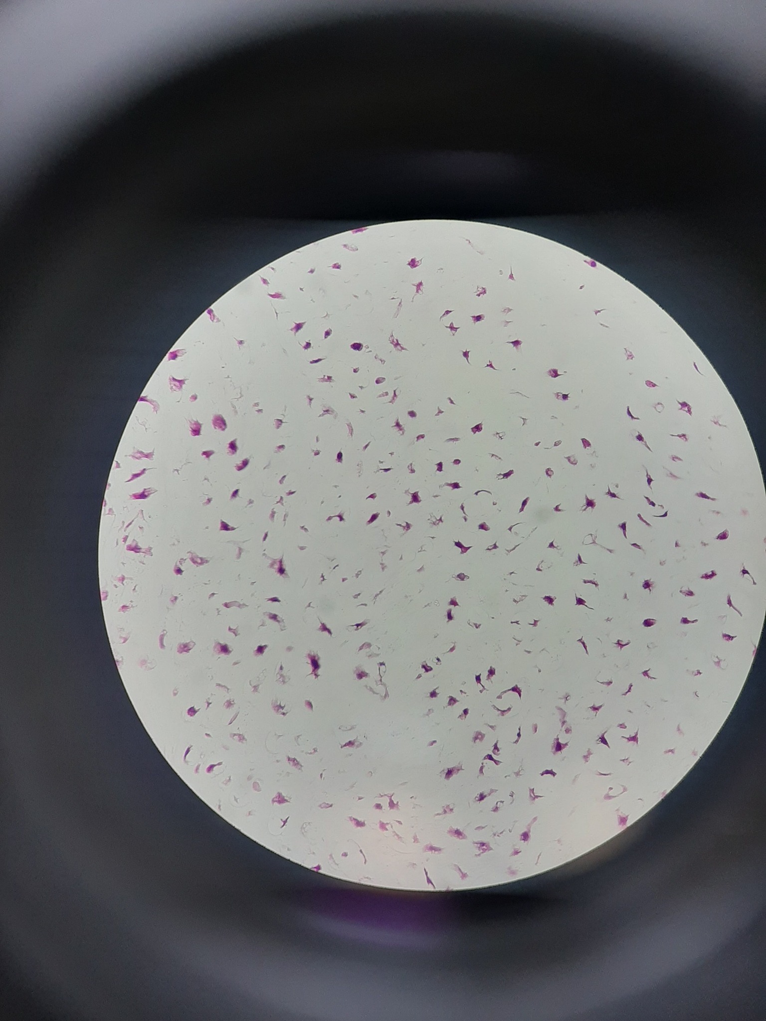 19-year-old male with a tumor in the middle phalanx of the fourth