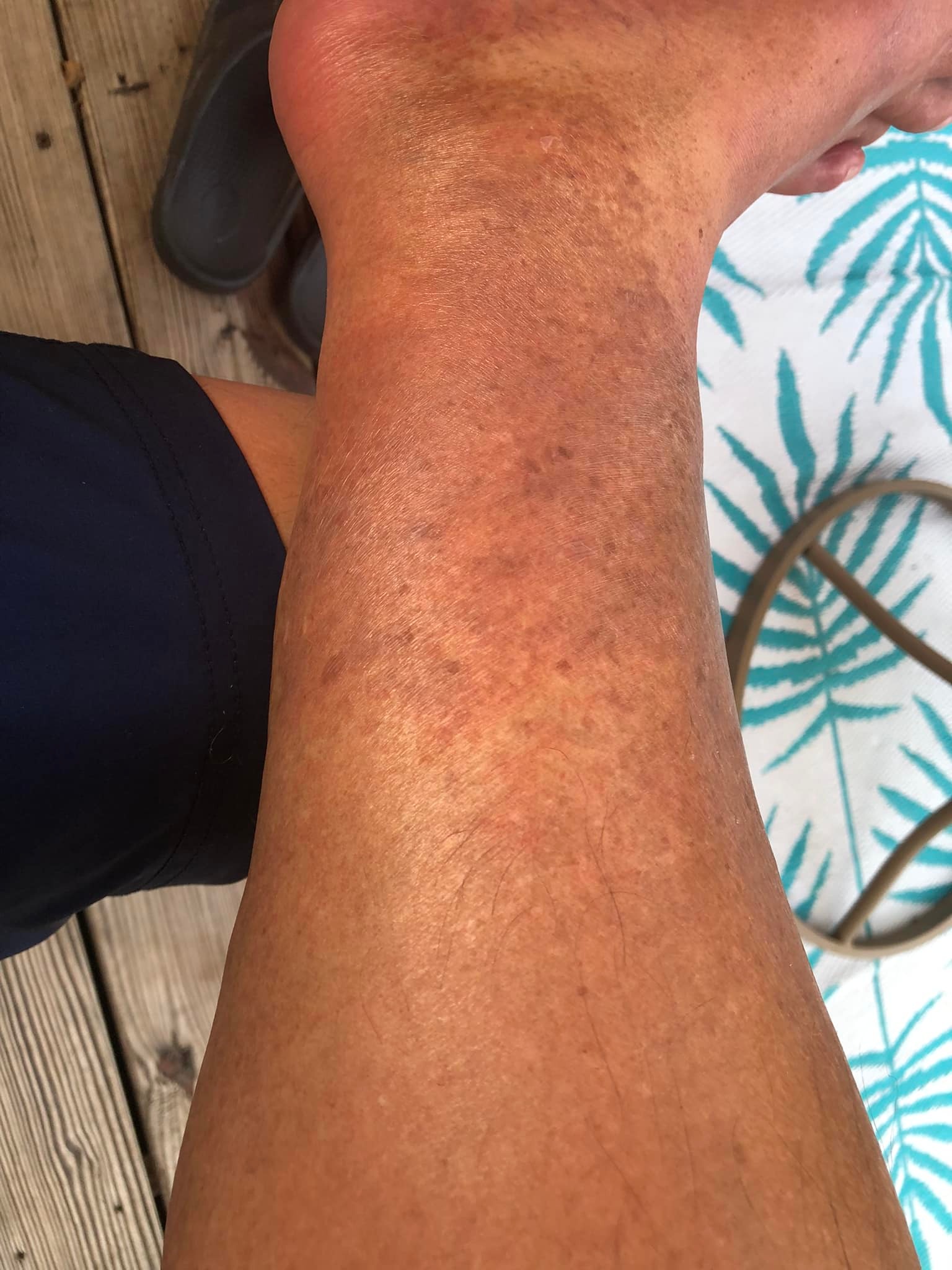 allergic reaction to glutathione Injections Recalled Niacinamide Body Care Joint Pain Treatments - Options:Serum + Derma Stamp Refill