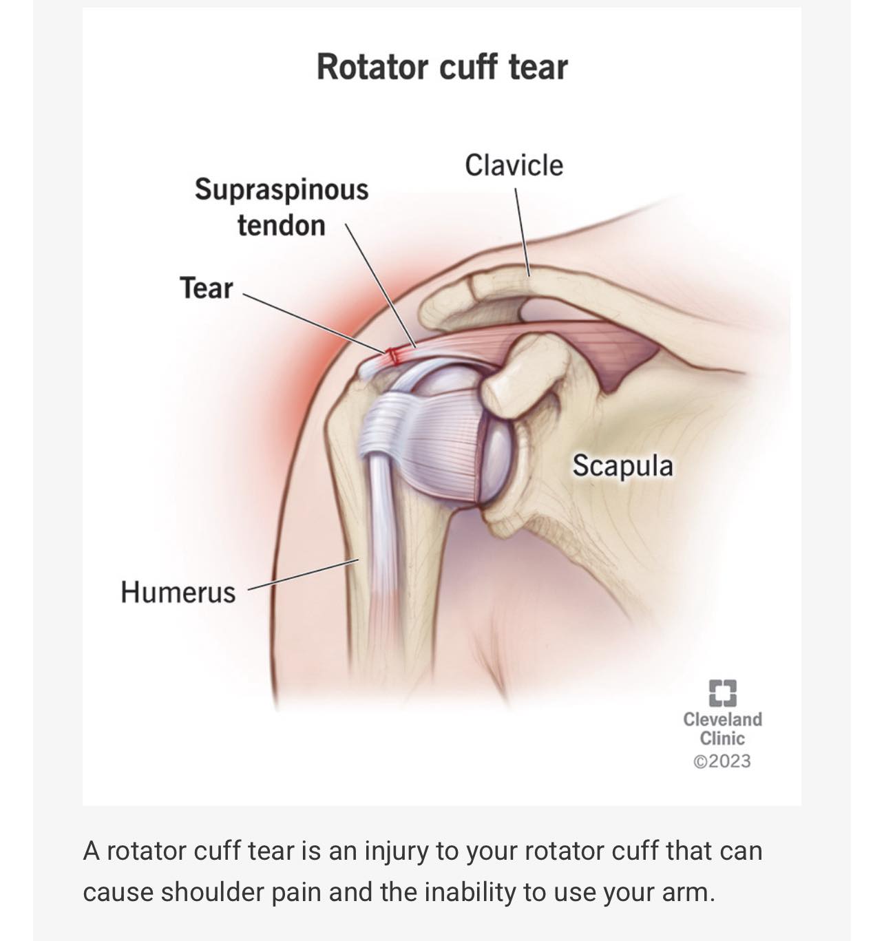bpc 157 for slap tear BPC-157 (Body Protection Compound) What is BPC-157? Complete guide