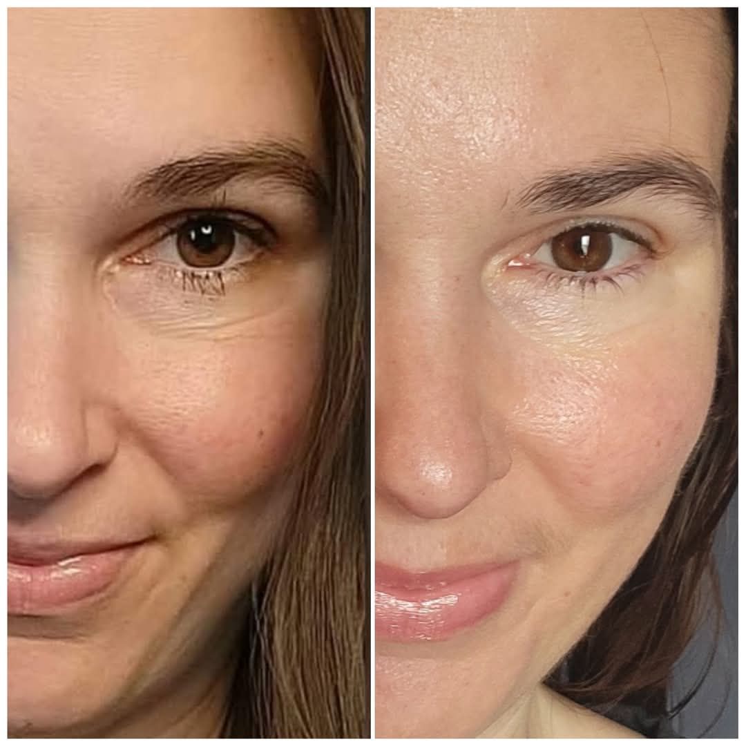 does ghk cu give you hollow cheeks When @hannahchody travels, her Squalane + Copper Peptide Rapid Plumping Serum comes with her. GHK-Cu copper peptides are among the most clinically studied actives in skincare. They signal your skin to produce Chondromalacia patellae: current options