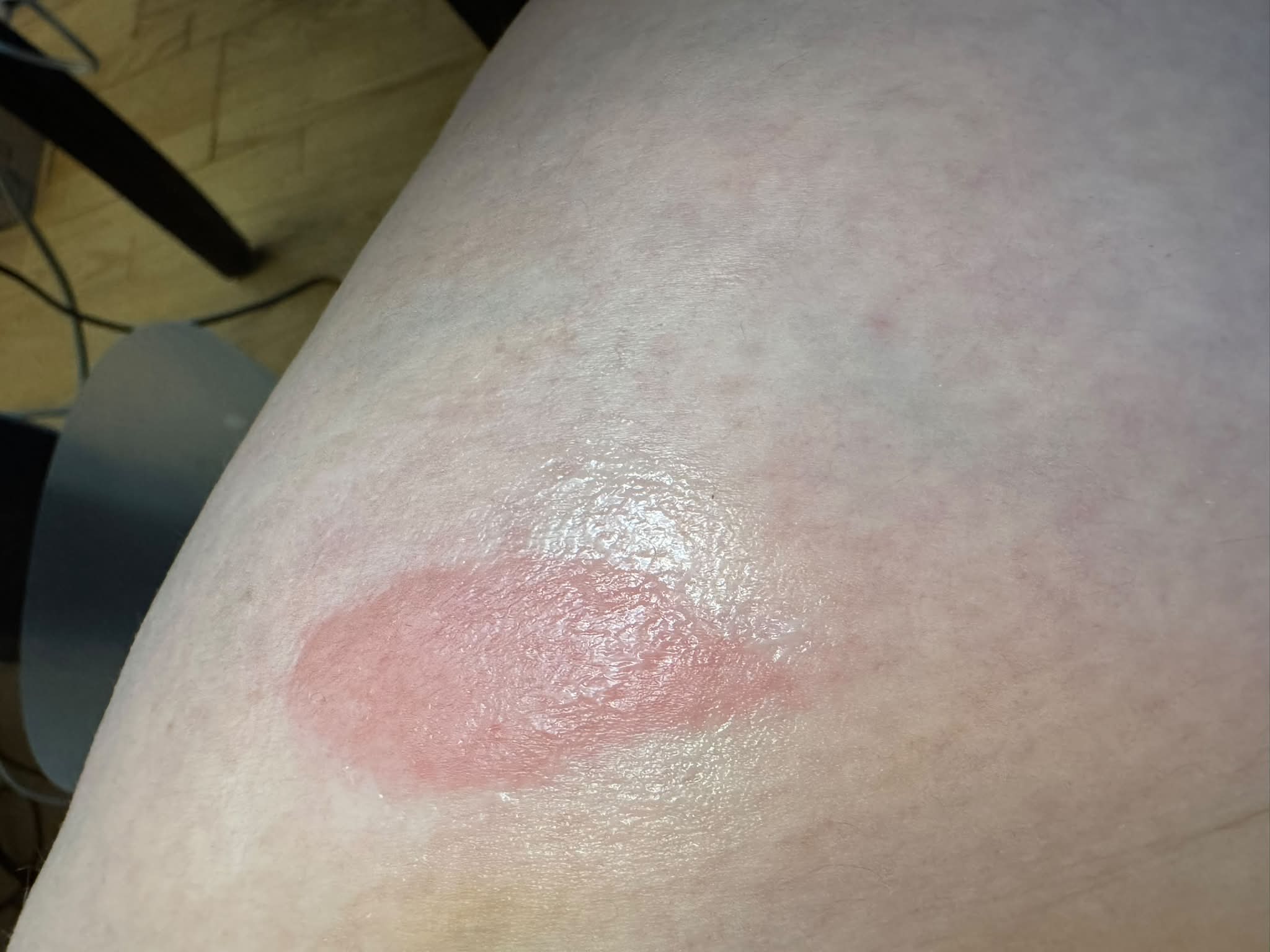itching after b12 injection What causes itchy site reactions with 12.5mg Zepbound doses? MIC B-12Injections Online |