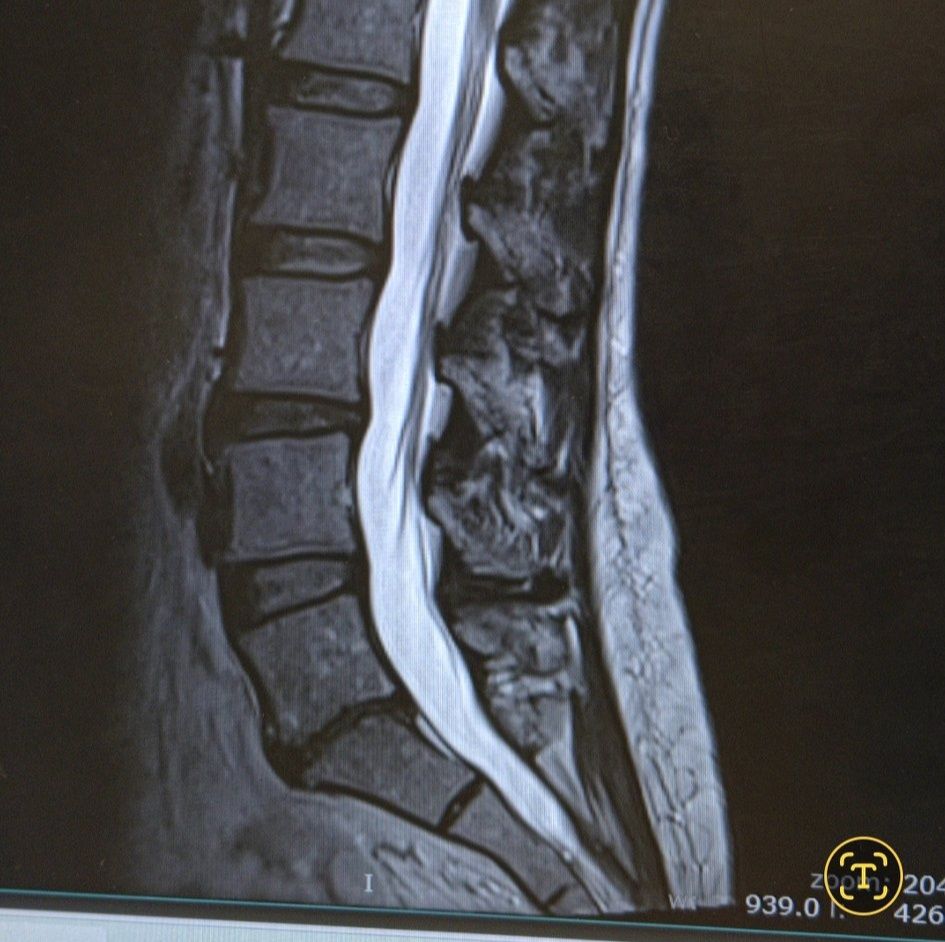 bpc 157 degenerative disc disease Wolverine Stack: Healing Faster with Peptides Has anyone found relief from