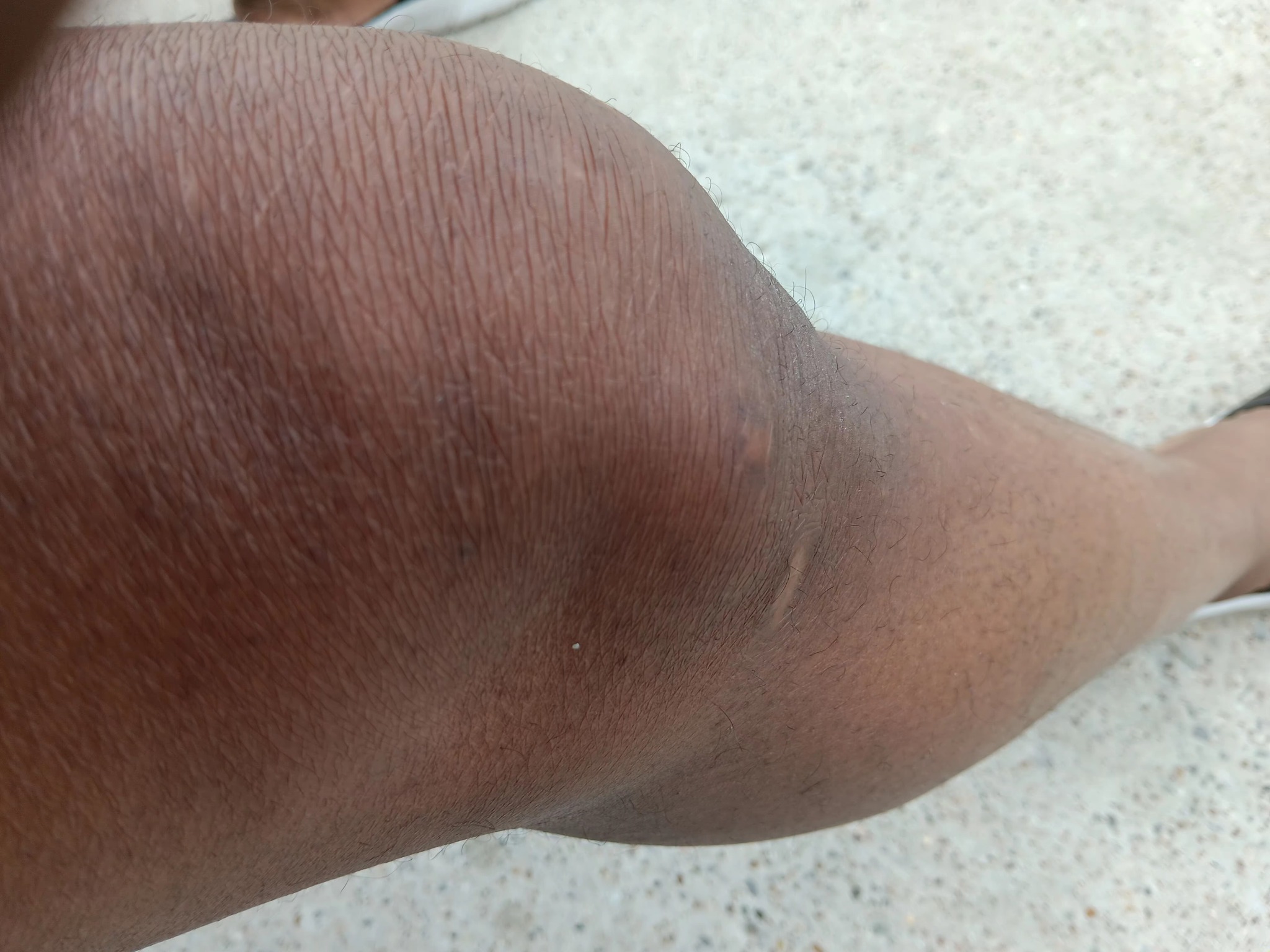 klow injection site pain reaction : r/PeptidePathways Klow Peptide Dosage: Complete Protocol  klow injection pain  Peptide