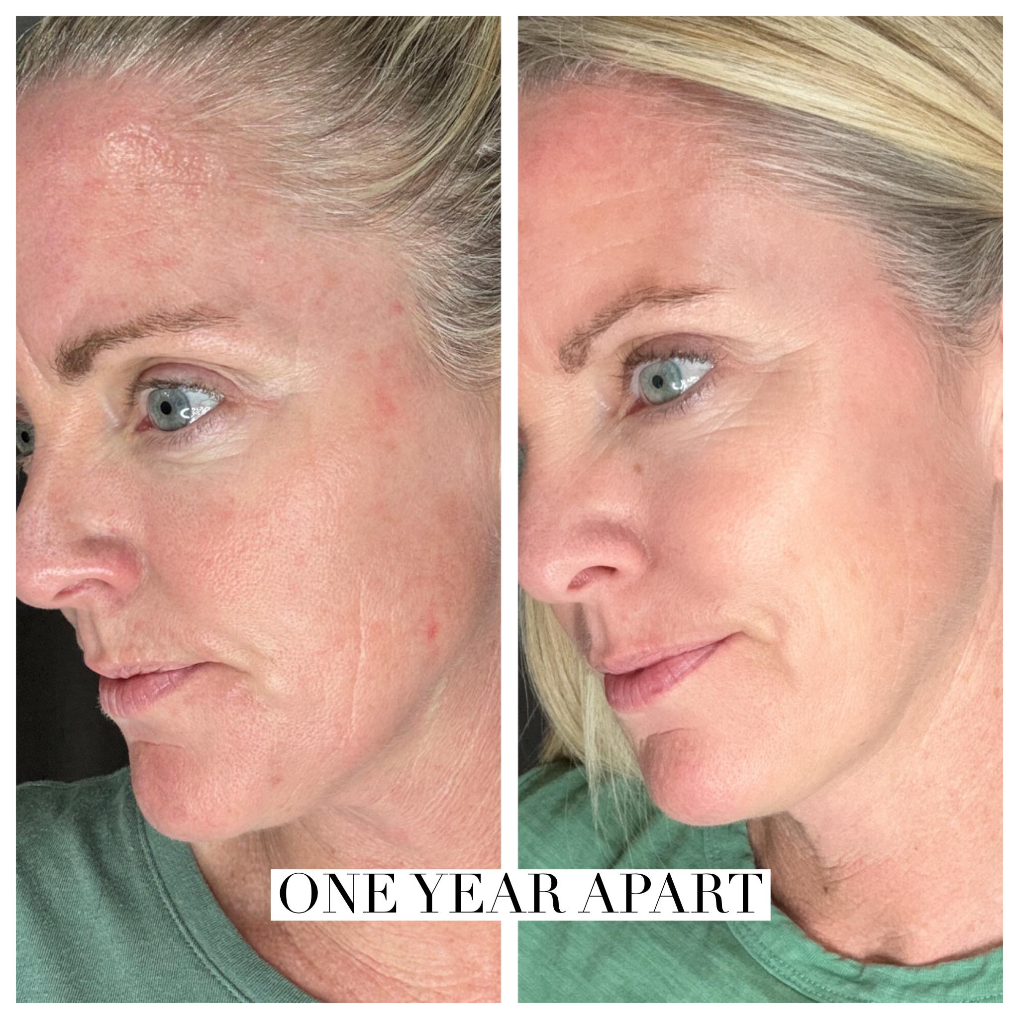 topical ghk cu acne scars looksmax.org 12 weeks in, and my skin has NEVER looked better! peptides are doing their thing. Alright, I need to give you an update—it's been 12 weeks since I started using GHK Peptide Therapy in SLC CHFUNCT Color:Rainbow