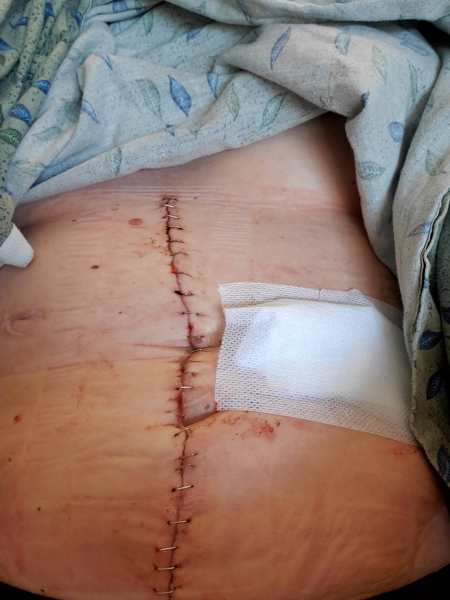 So, this is what happened. Back in April, 9th to be exact my doctor prescribed the highest dose of the weight loss medication Wegovy. I've been on Ozempic before, January 2024. Nothing