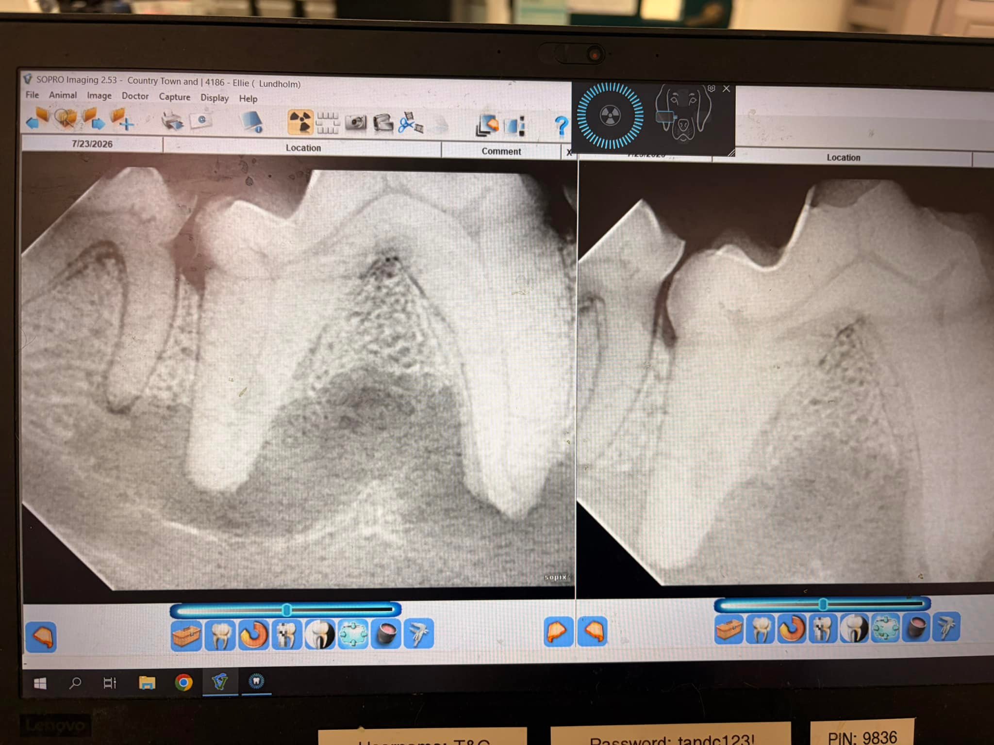 chie♥️ What is the diagnosis for a large pulp canal in a fractured tooth?