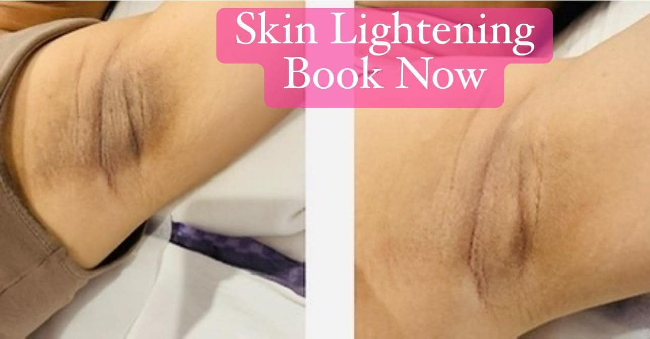 glutathione for anal lightening HEADS UP‼️ BRAND NEW treatment alert ❗️ 🌟 INTIMATE 🌟 Yes you read that correctly.. previously known as bleaching or intimate bleaching will be added to my services from N-Acetyl-L-tryptophanamide 2382-79-8 Face Mist Skin Care Benefits:All (5 Different Booster Shots)
