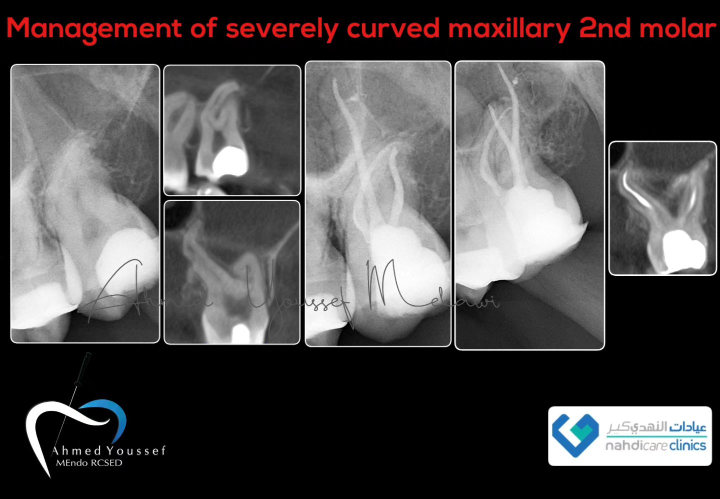 Ahmed - Management of severely curved & long roots in maxillary second ...
