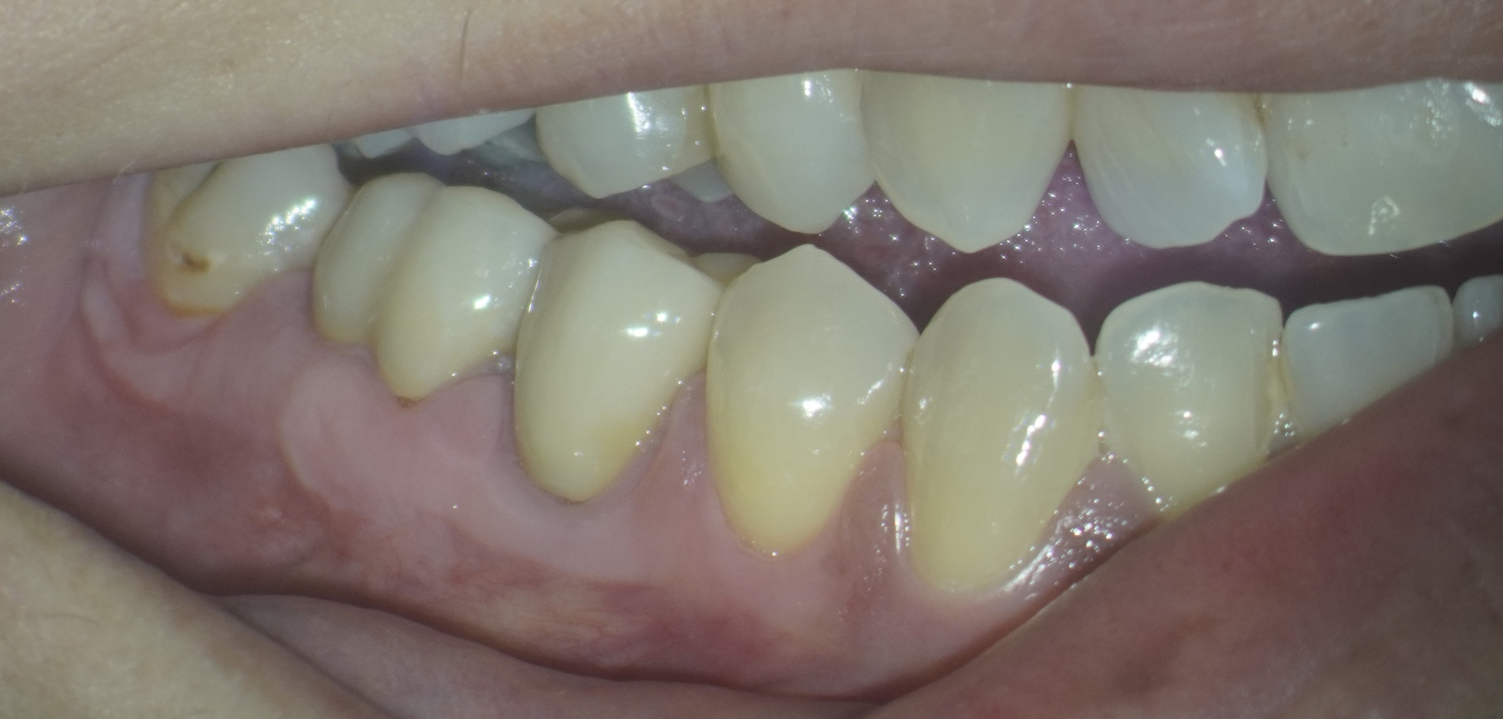 Advances in minimally invasive periodontal therapy with biologics