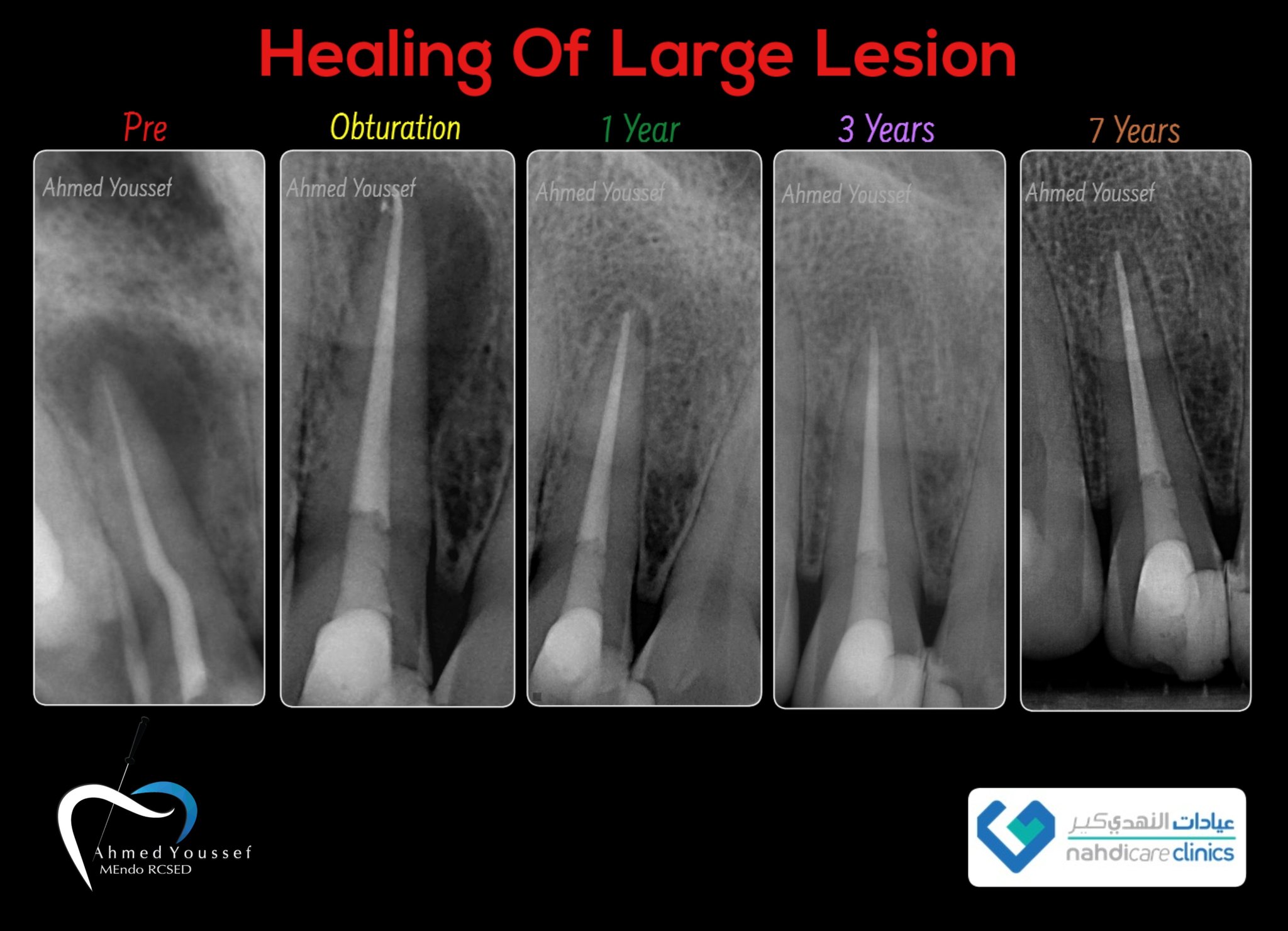 Ahmed - The presence of a J-shaped lesion on a radiograph is not ...
