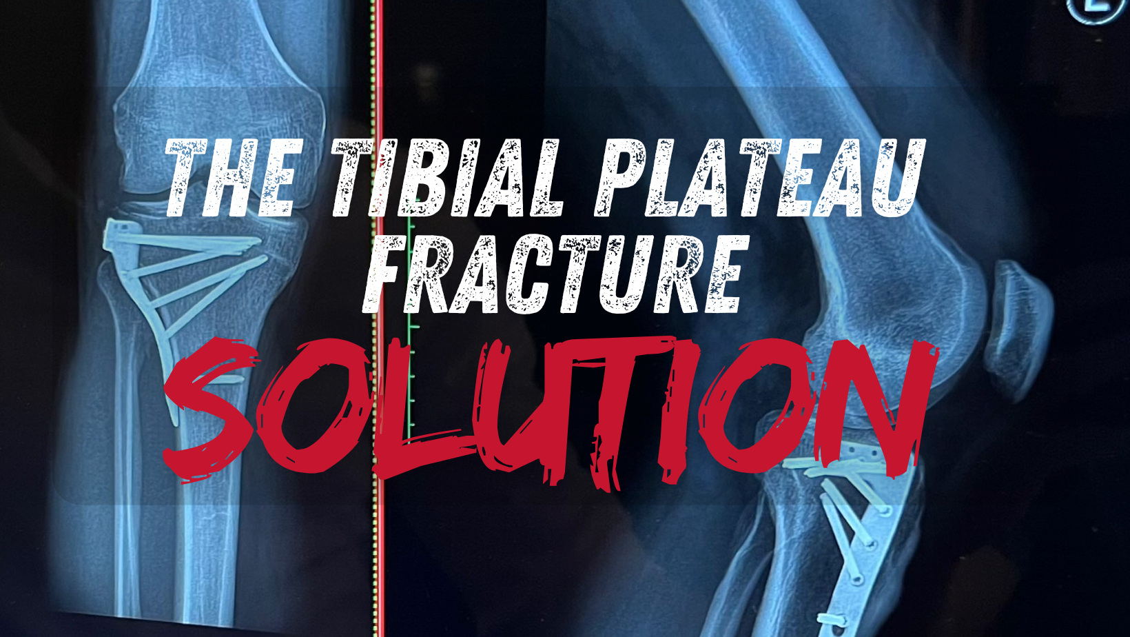 The Tibial Plateau Fracture Solution | Facebook