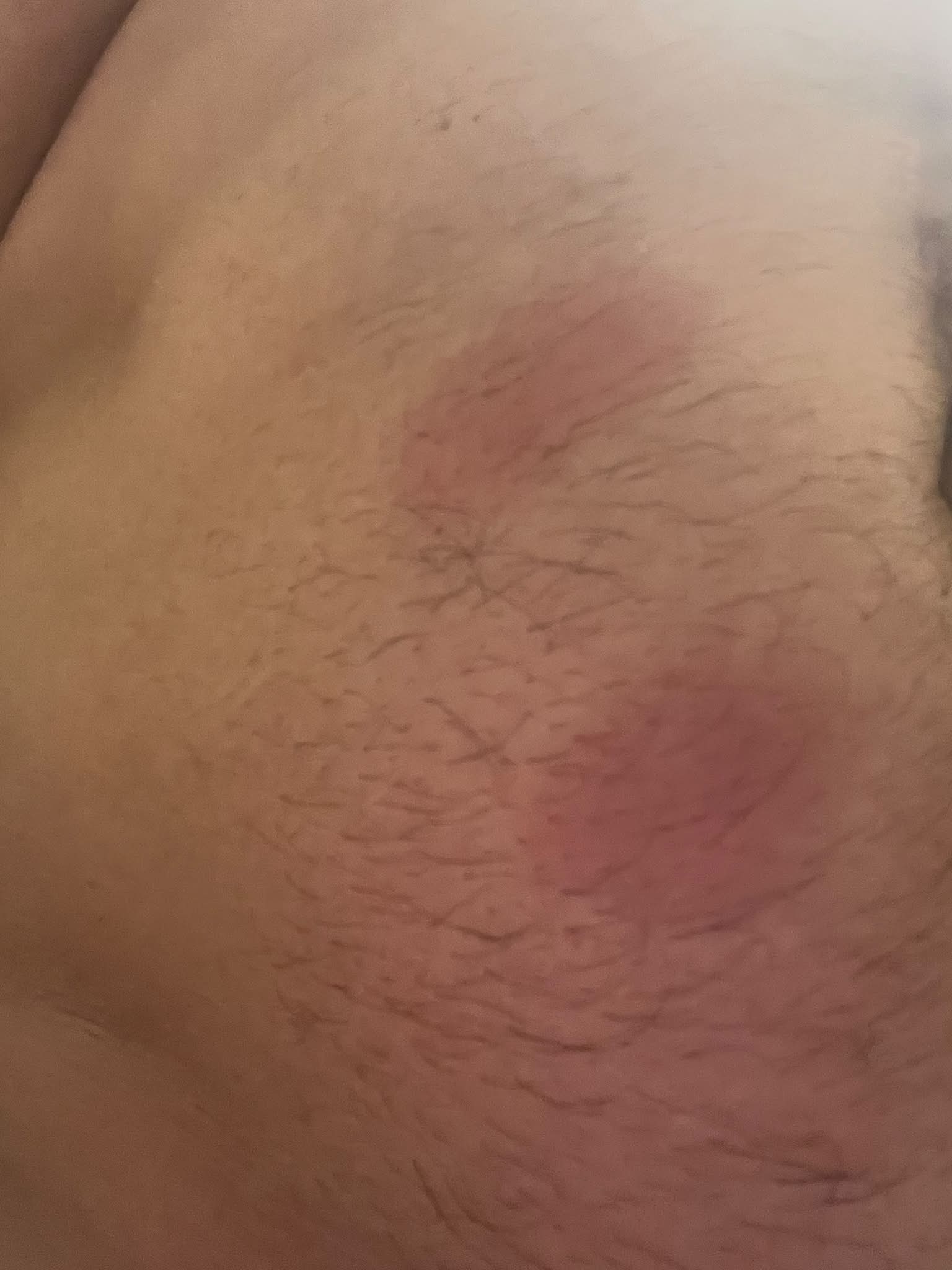 klow reddit Starting taking 2 days ago. The morning after my first injection, I had a slight pain by the injection area. Nothing crazy and it went away after a hour or two amino acids injection Electrolyte Flavour:Yuzu glutathione injection vs iv