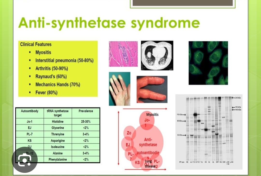 Antisynthetase Syndrome-ASSD | Facebook