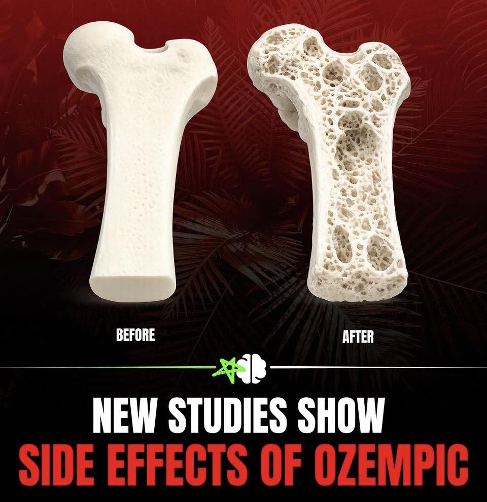 does tirzepatide cause bone density loss Do weight medications osteoporosis? The honest answer is more nuanced than the headlines suggest., When you lose significant weight  by any method  your bones adapt to carrying less load. How weight loss treatments cause