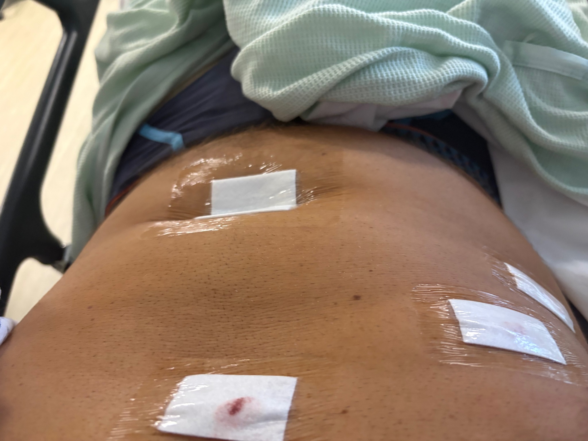 Has anyone used semaglutide or mounjaro after gallbladder removal? I'm nearly 4 weeks post op and wondering if it's safe to use now. Thankyou