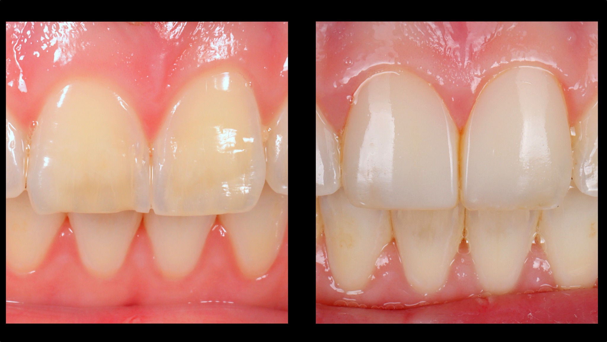 Résine Composite Dentaire Tetric N-Ceram Blanche (BLL Dental) - Pour Facettes Et Restaurations