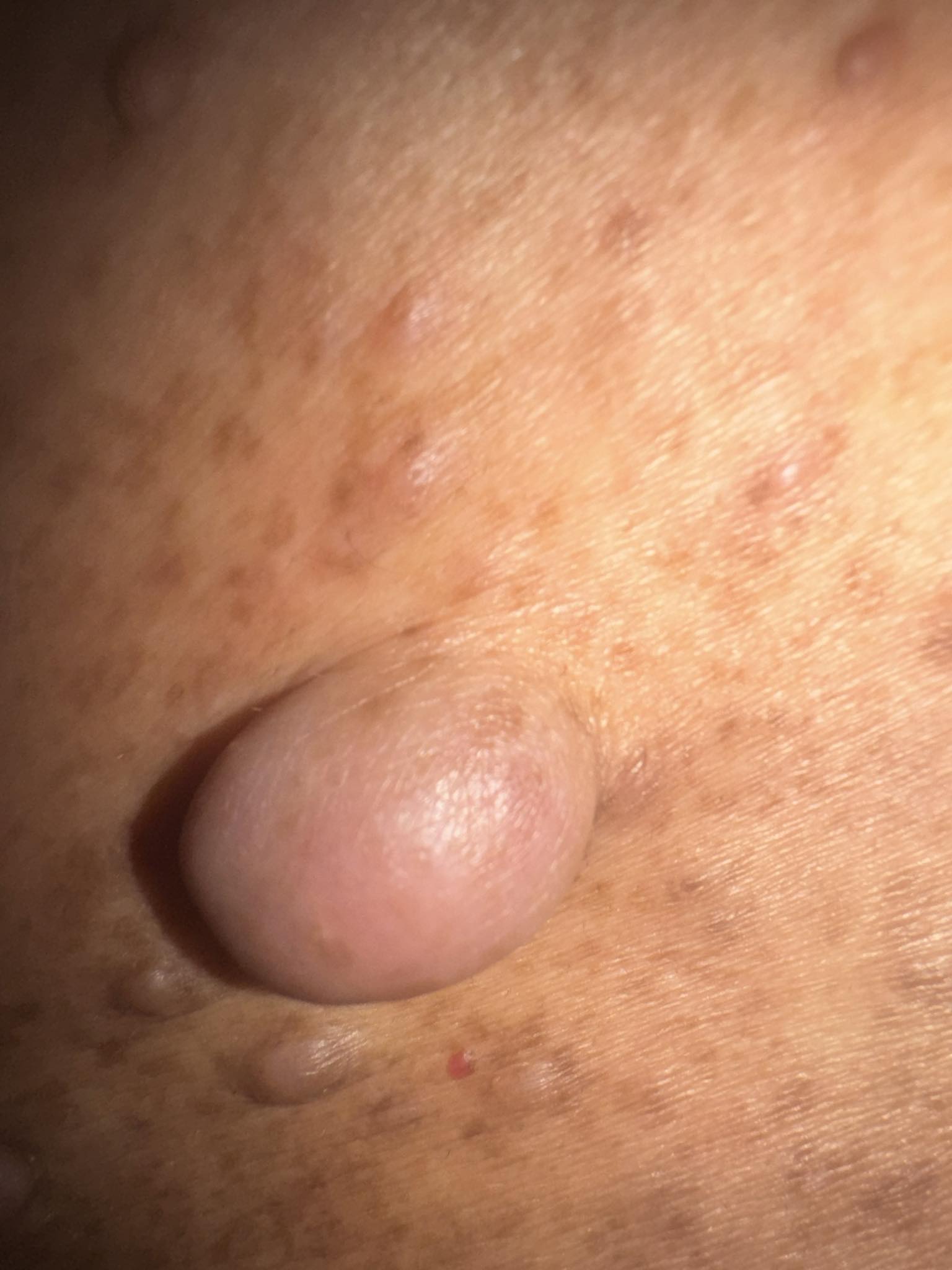 glutathione kill neurofibromas Neurofibroma growth on lower back Magicg Egyptian Glutathion Ultra كريم ميديكيوب لترطيب البشرة Size:100 mg