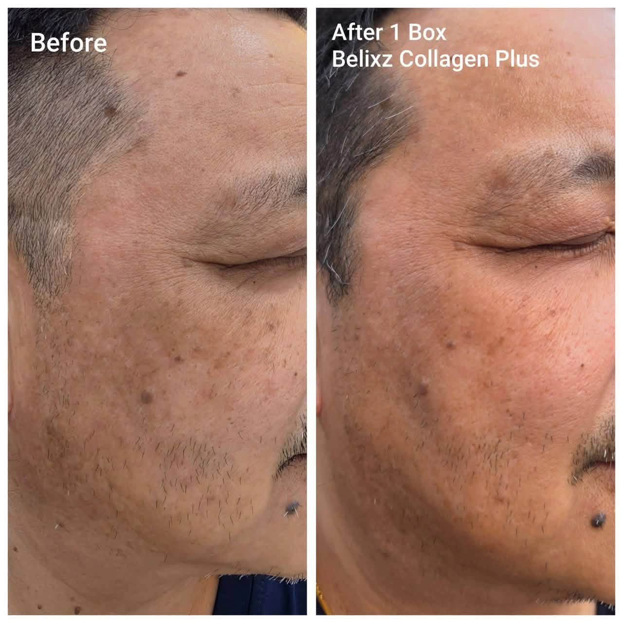 belo glutathione with collagen before and after Nutaceuticals + : Health & Household If dark areas are your