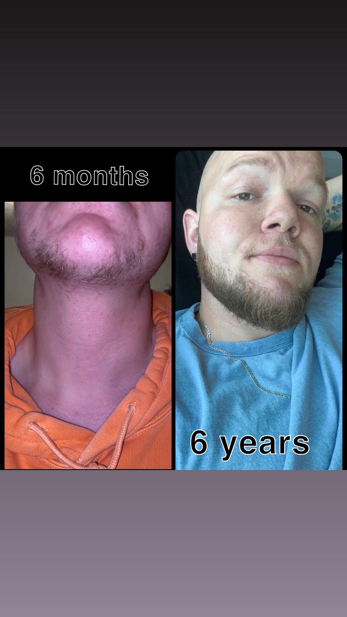 l-carnitine l-tartrate beard reddit How to grow a with Kallmann syndrome? It also helps maintain L-carnitina Liquida De Triple vitamin b12 benefits for men Count:50ct