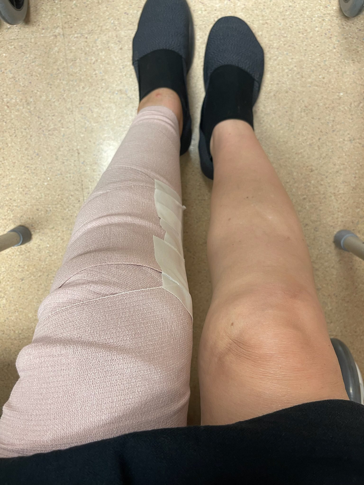 2 days post op from TLKR. I actually feel great. When the nerve 