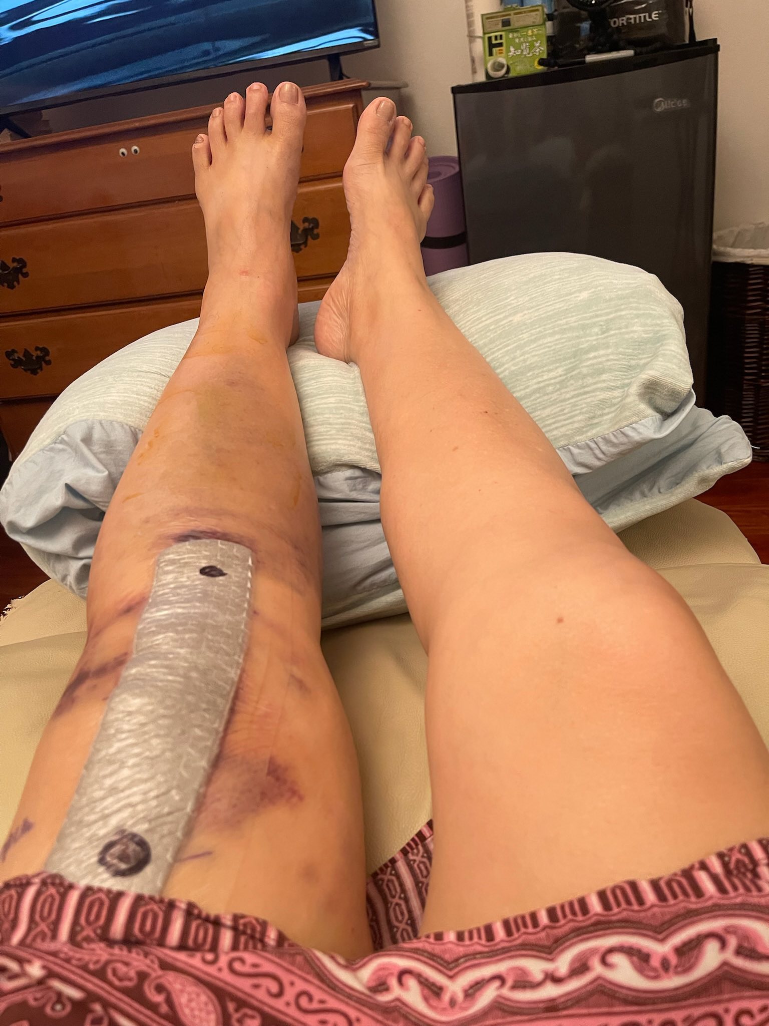 2 days post op from TLKR. I actually feel great. When the nerve 