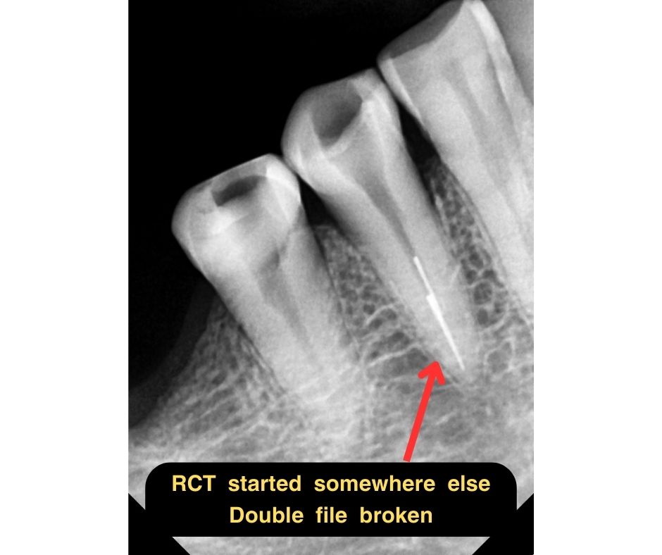 ( DOUBLE FILE BYPASS )... - Smiles & Braces Dental Clinic | Facebook