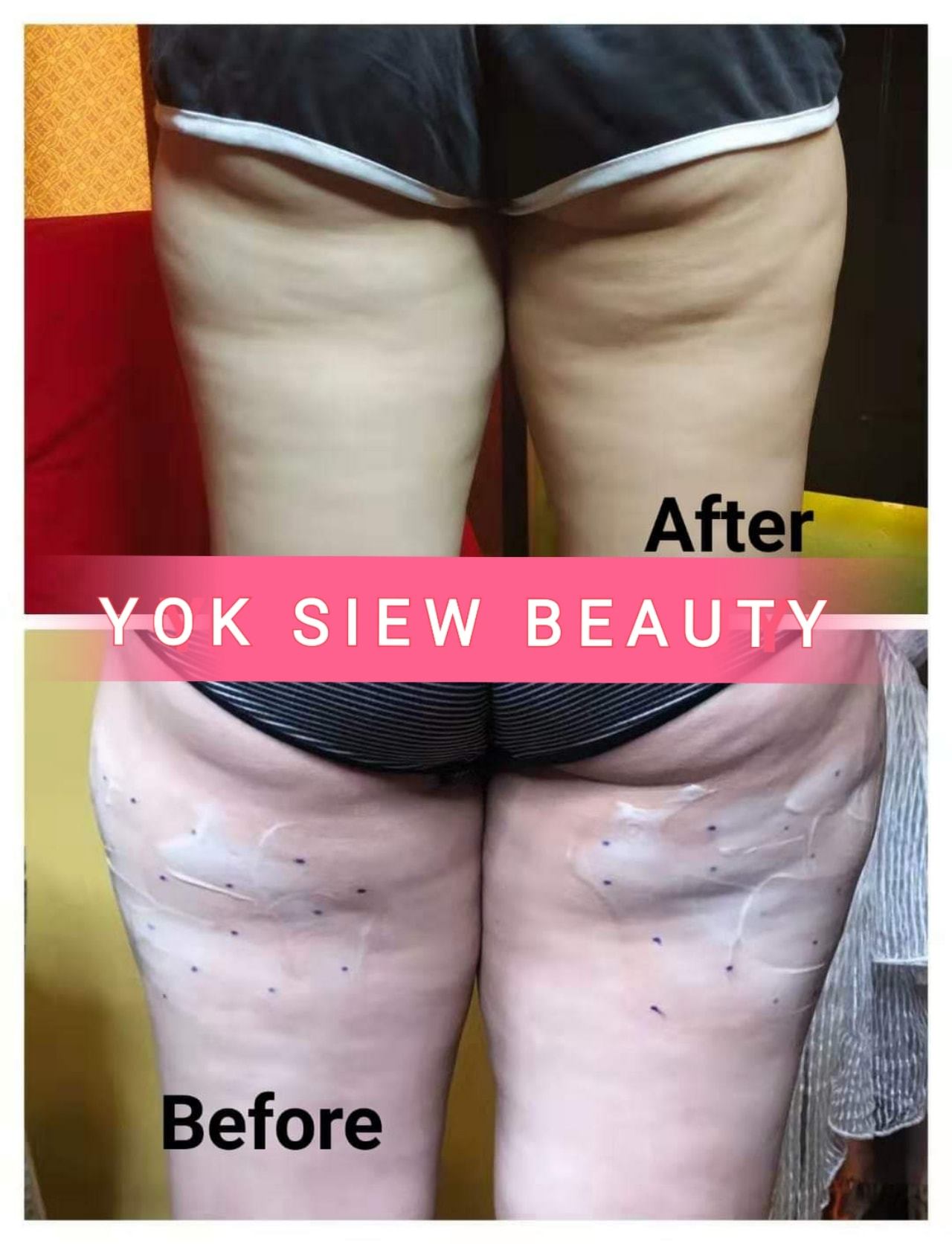 Muar Yok Siew Centre 溶脂瘦大腿 加强版 顾客做了三次的加强版溶脂针效果 什么是溶脂针 溶脂针 是全新的 注射溶脂减肥 开刀 麻醉 痛苦 即做即走