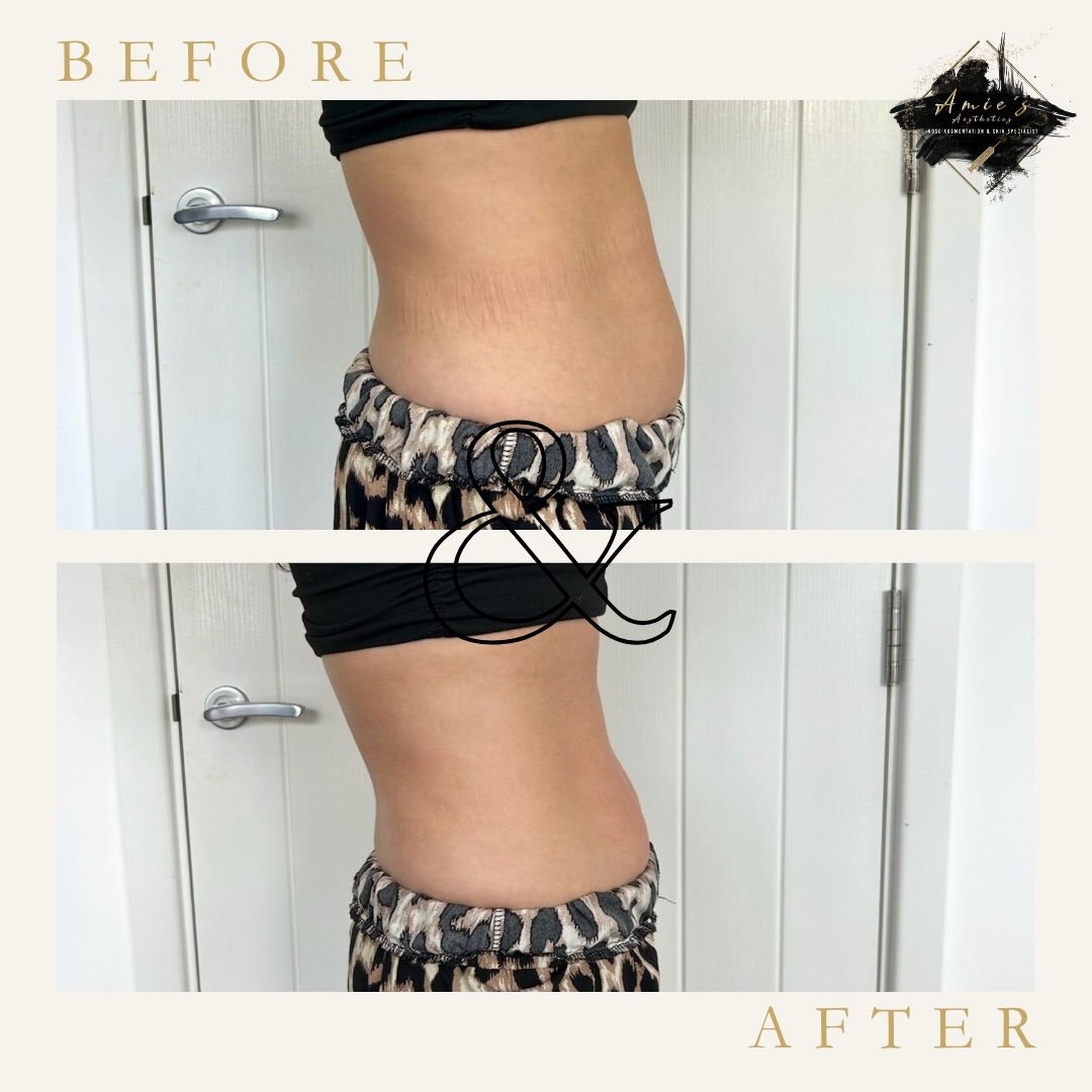 lemon bottle fat dissolving before and after stomach Treatments Bromley Lemon Bottle Fat Dissolver -