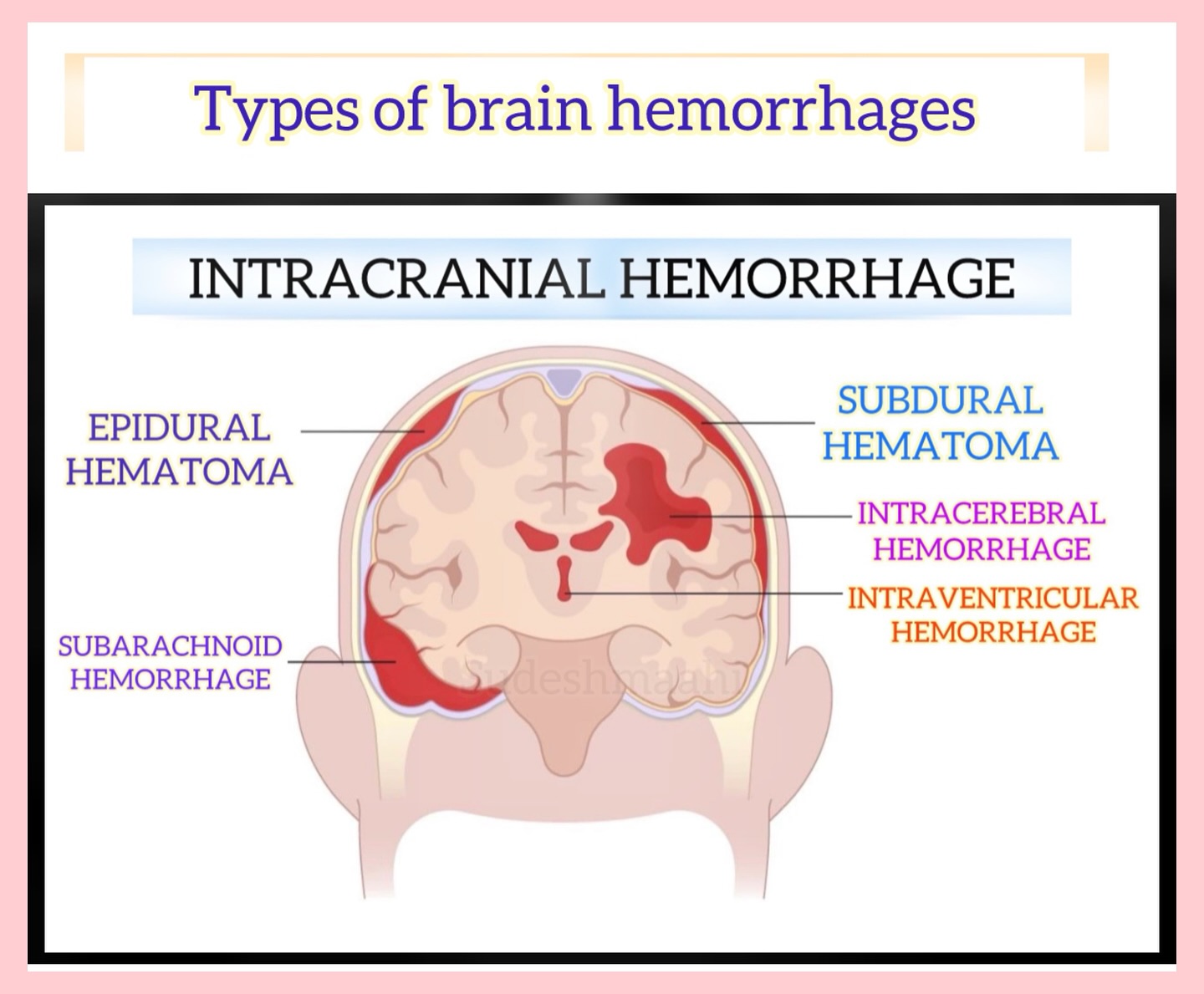 The Nursing - Types of brain hemorrhages -INTRACRANIAL HEMORRHAGE Types ...