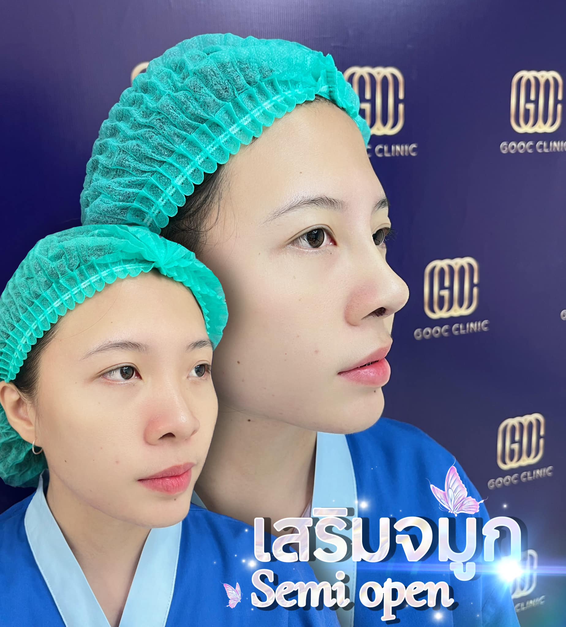 Revi... - Gooc clinic คลินิกศัลยกรรม:ความงามยโสธร-ชัชวาลคลินิก | Facebook