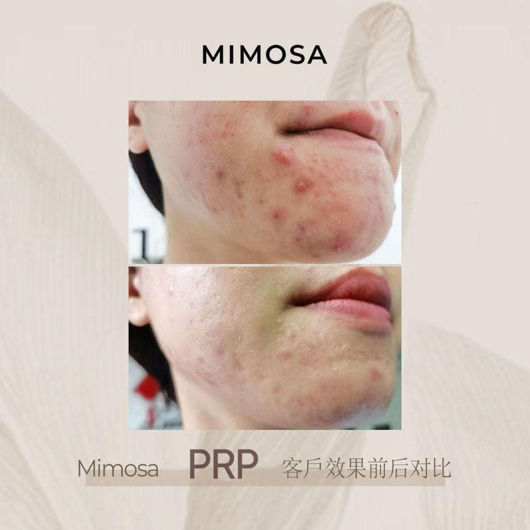 PRP成为你肌肤修护的秘密武器 ... - Mimosa Skin Beaute Academy
