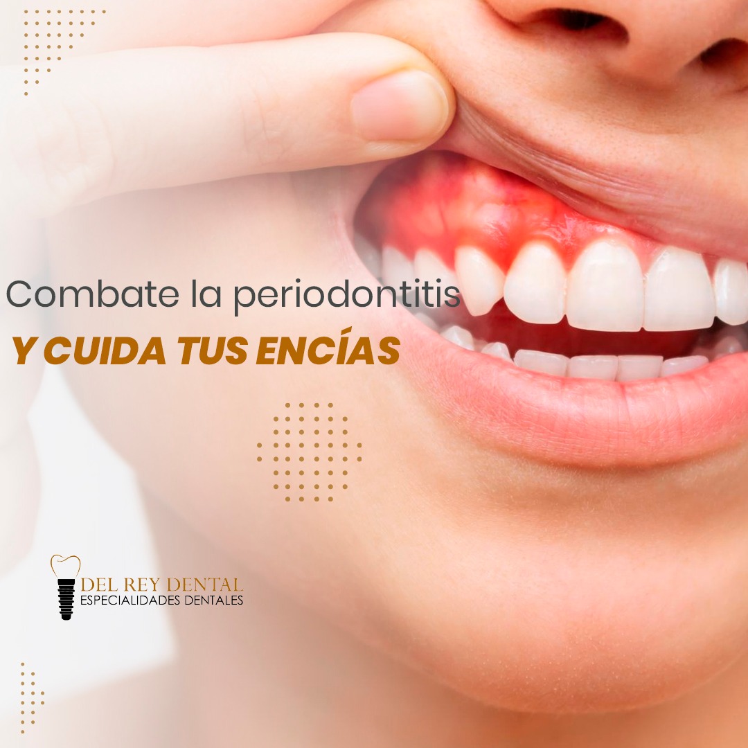 Del Rey Dental - La periodontitis es una etapa avanzada de...
