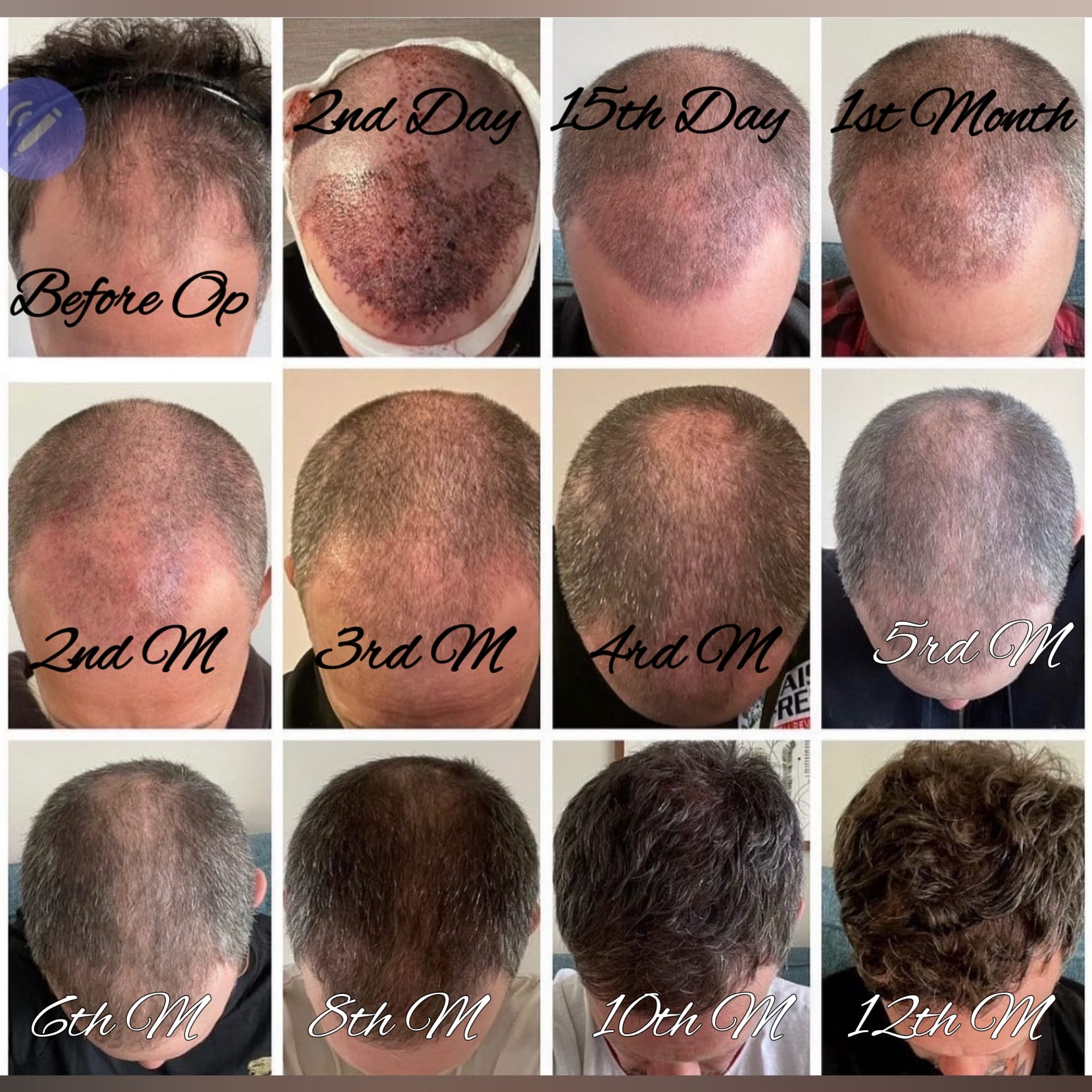 bpc 157 hair transplant BPC-157 Naturally Regrow and Get Thicken