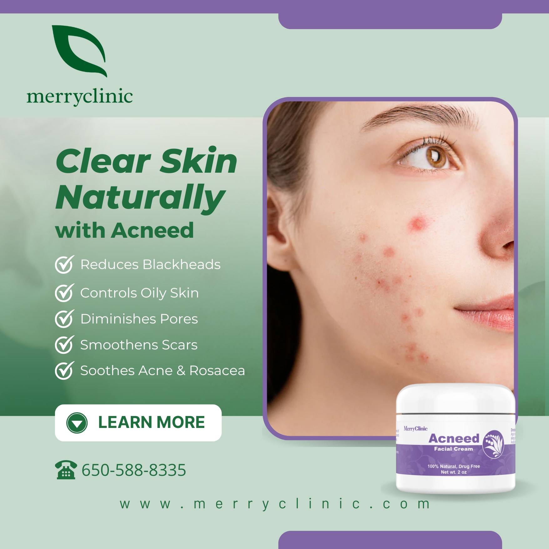 Picture of Merry - Acneed Cream is a powerful solution for acne and rosacea ...