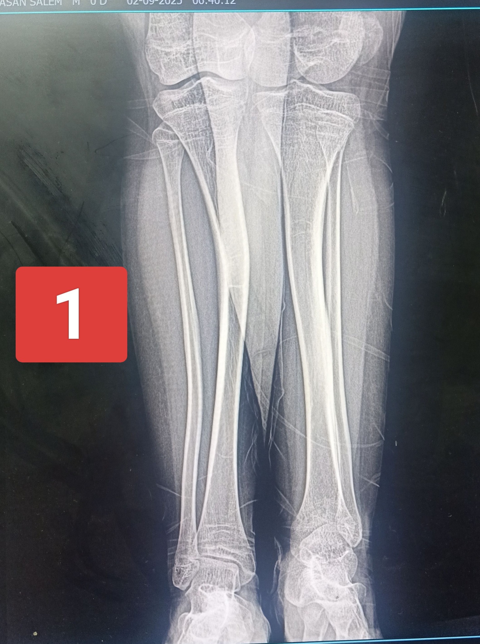 Xray Scanogram Youtube Scanogram Both Lower Limb🏥 . . #xray_doctor