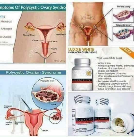 polycystic ovaries glutathione yung mga gustong magka anak😊 🌸Luxxe White Enhanced is advisable for (PCOS) 🌸According to WebMD, Ovarian Syndrome (PCOS) is a problem in which a woman's hormones are out of balance.It GHK-Cu | ATHLEAN Smoothing skin Size:200 mg