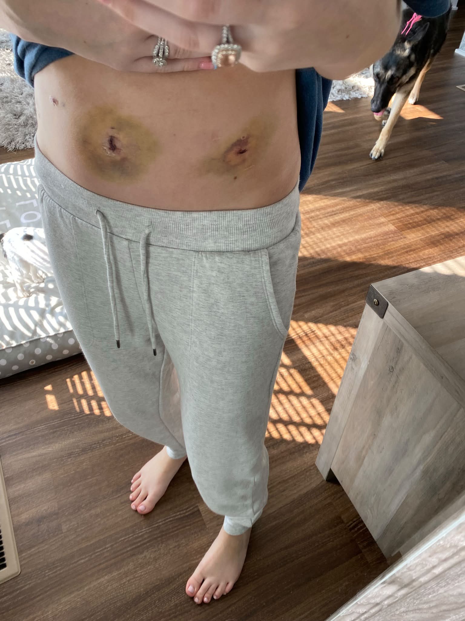 bpc-157 endometriosis reddit They said it's “just a bad period.” But for millions, means pain that disrupts careers, relationships, sleep, and daily life. This is not normal. This is not “part of being a Injection Pen