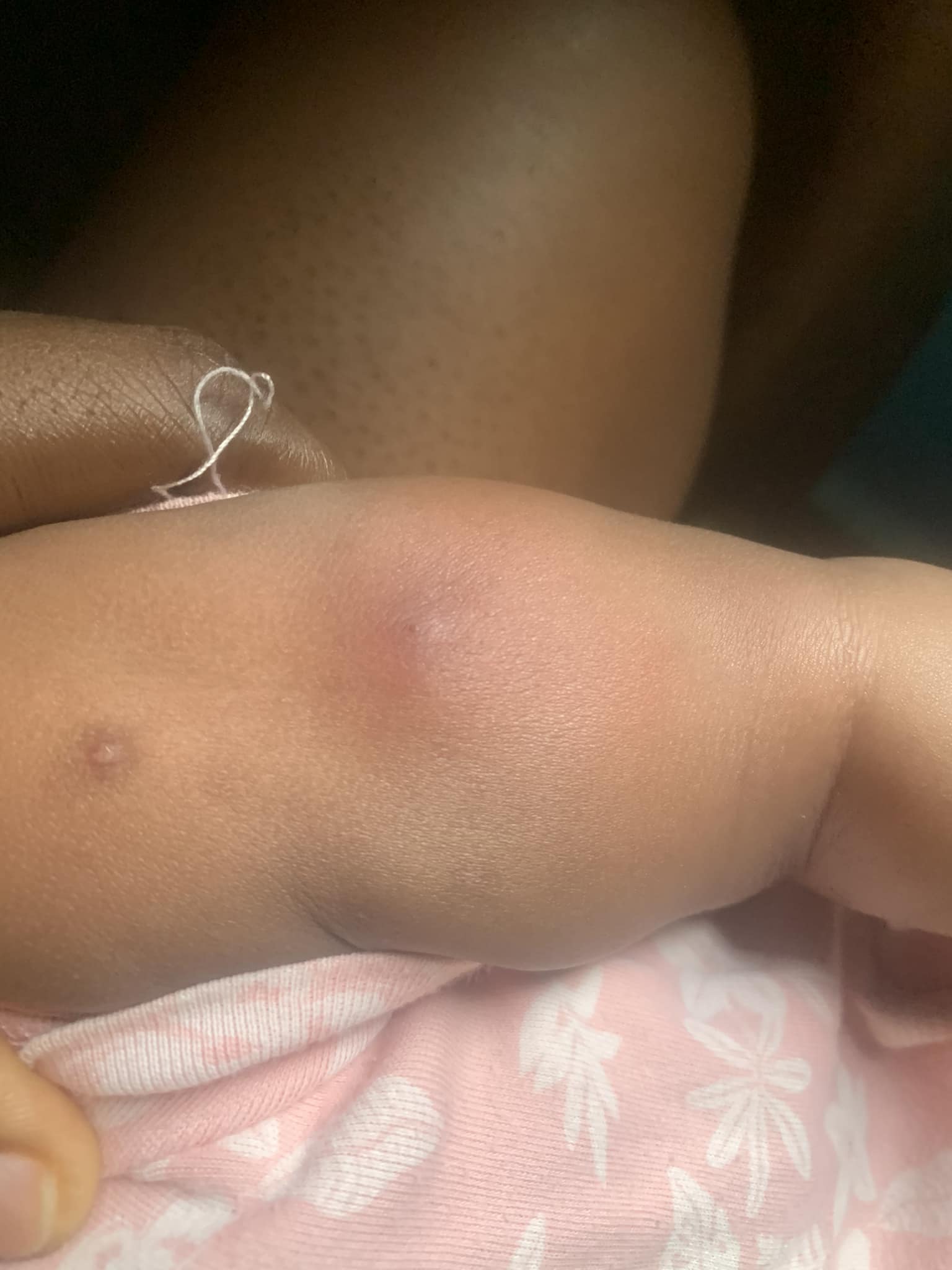 little bump came up after b12 injection Good morning doctors, pls my 6months plus baby is having this on her arm... the 1st one there is the BCG injection... then the 2nd one up yesterday... pls I IV Therapy Augusta GA red blood cell support Color:Purple Silk