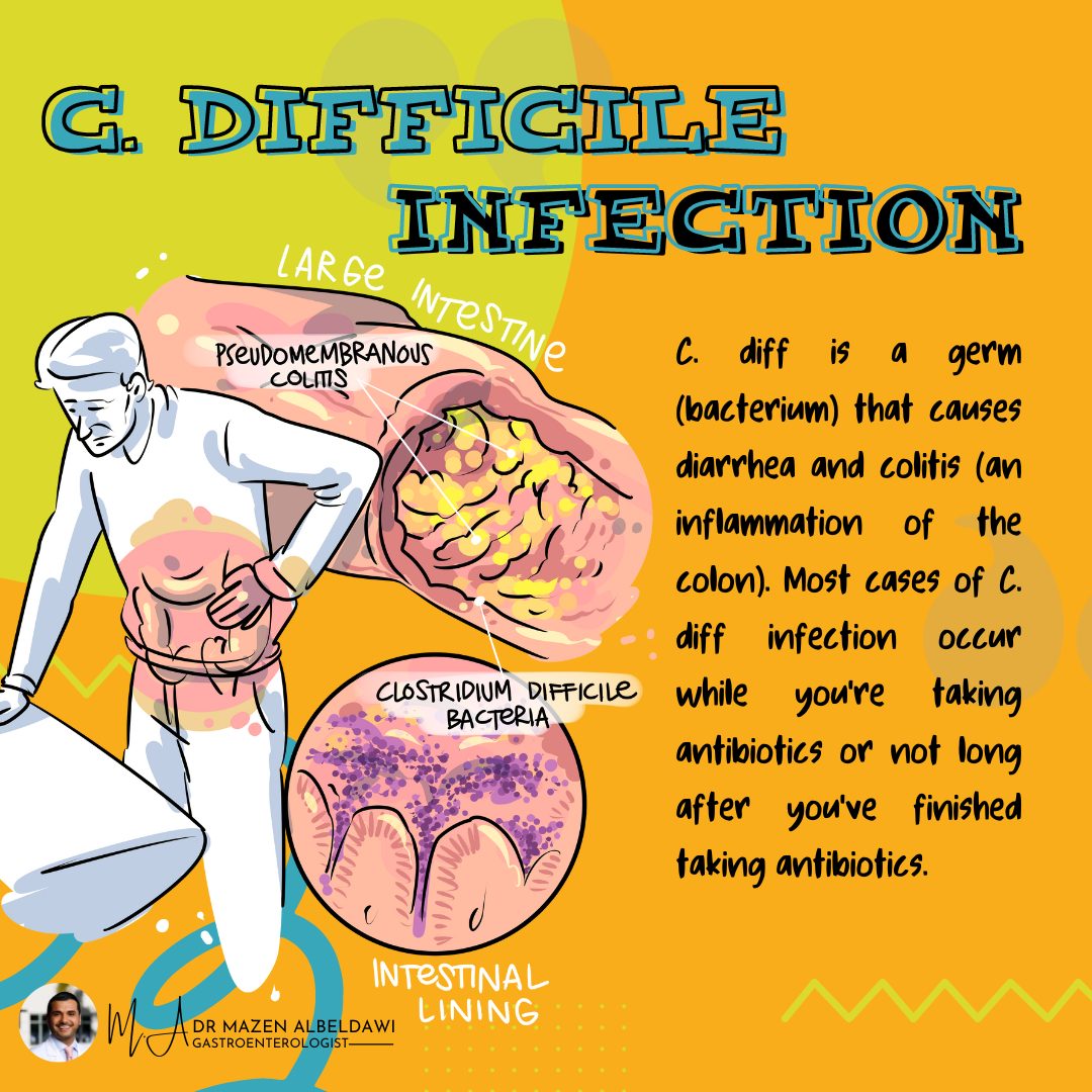 Did you know? C. diff is a germ that causes diarrhea and inflammation of the colon. Most cases of C. diff infection occur when you are taking antibiotics or soon after you've