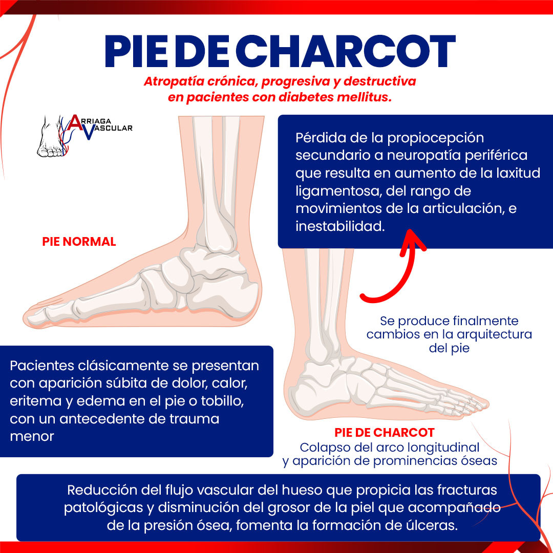 👣 Descubre el pie de Charcot: una... - Arriaga Vascular