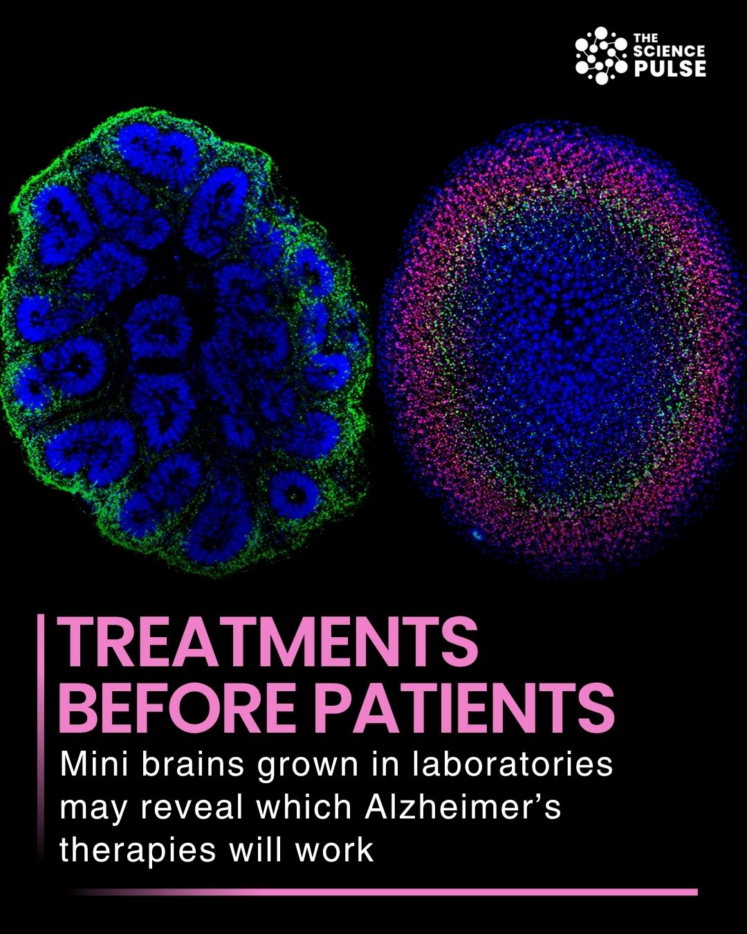 Scientists have created patient-derived brain organoids, often