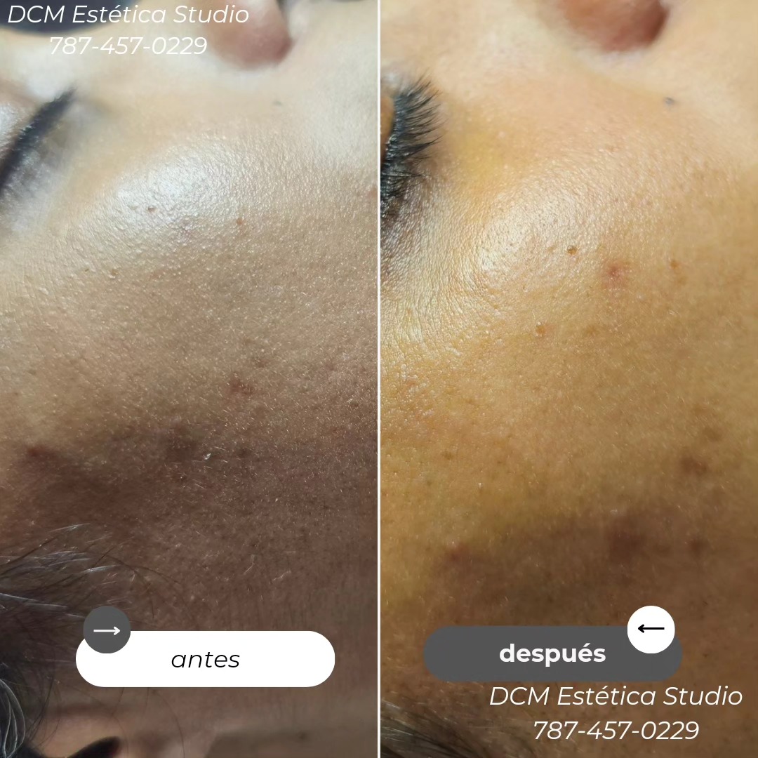 dcm-el-dermaplaning-es-un-tratamiento-est-tico-que-ofrece-varios