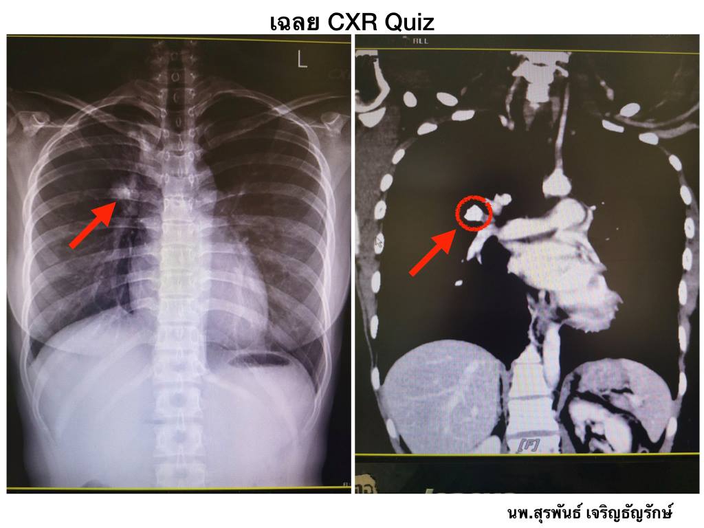 เฉลย CXR Quiz - Medicine รพ.ขอนแก่น | Facebook