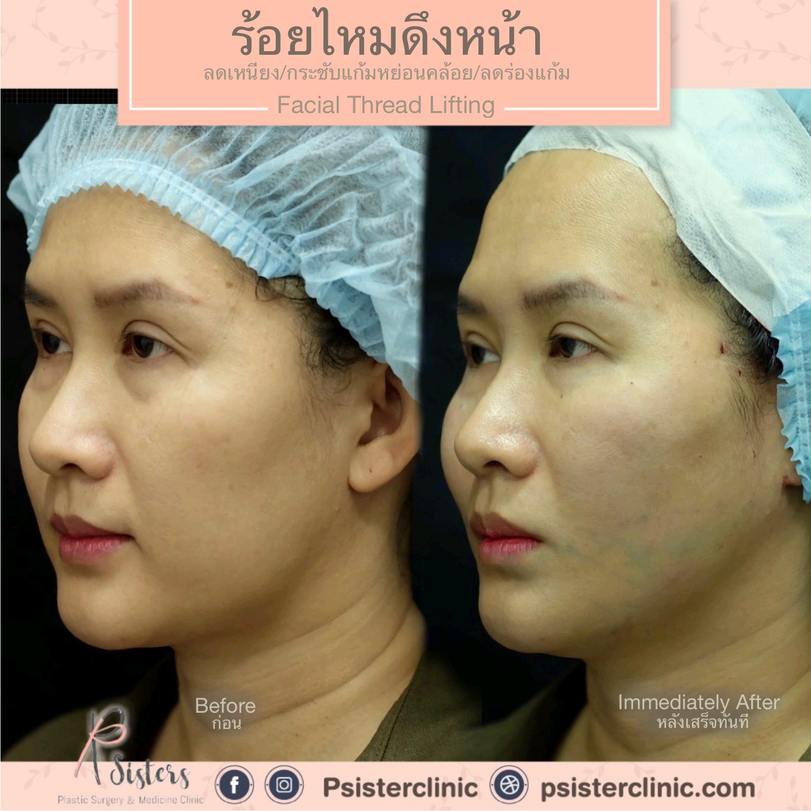 การดึงหน้าและยกกระชับส่วนที่หย่อนคล้อยด้วยการ 