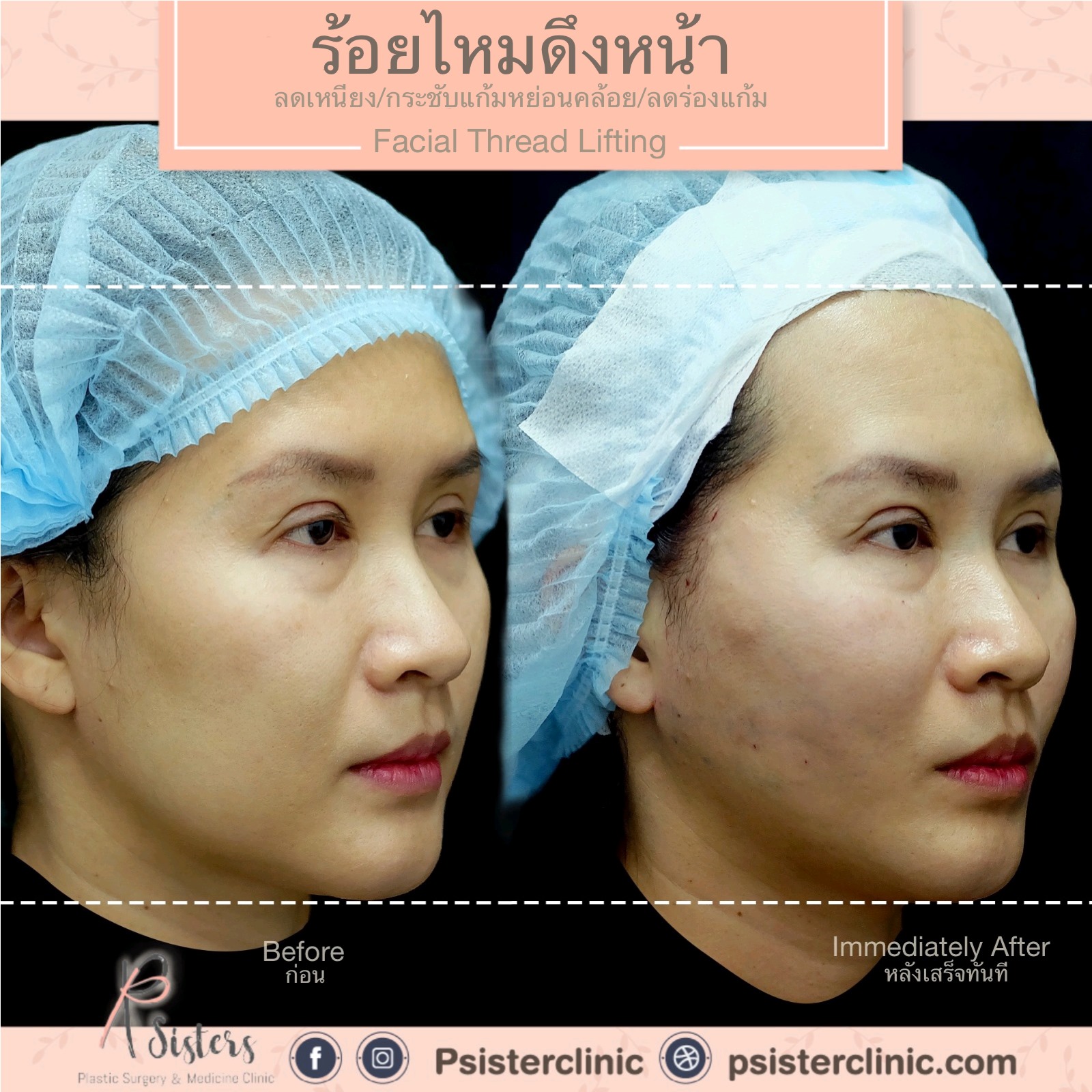 การดึงหน้าและยกกระชับส่วนที่หย่อนคล้อยด้วยการ 