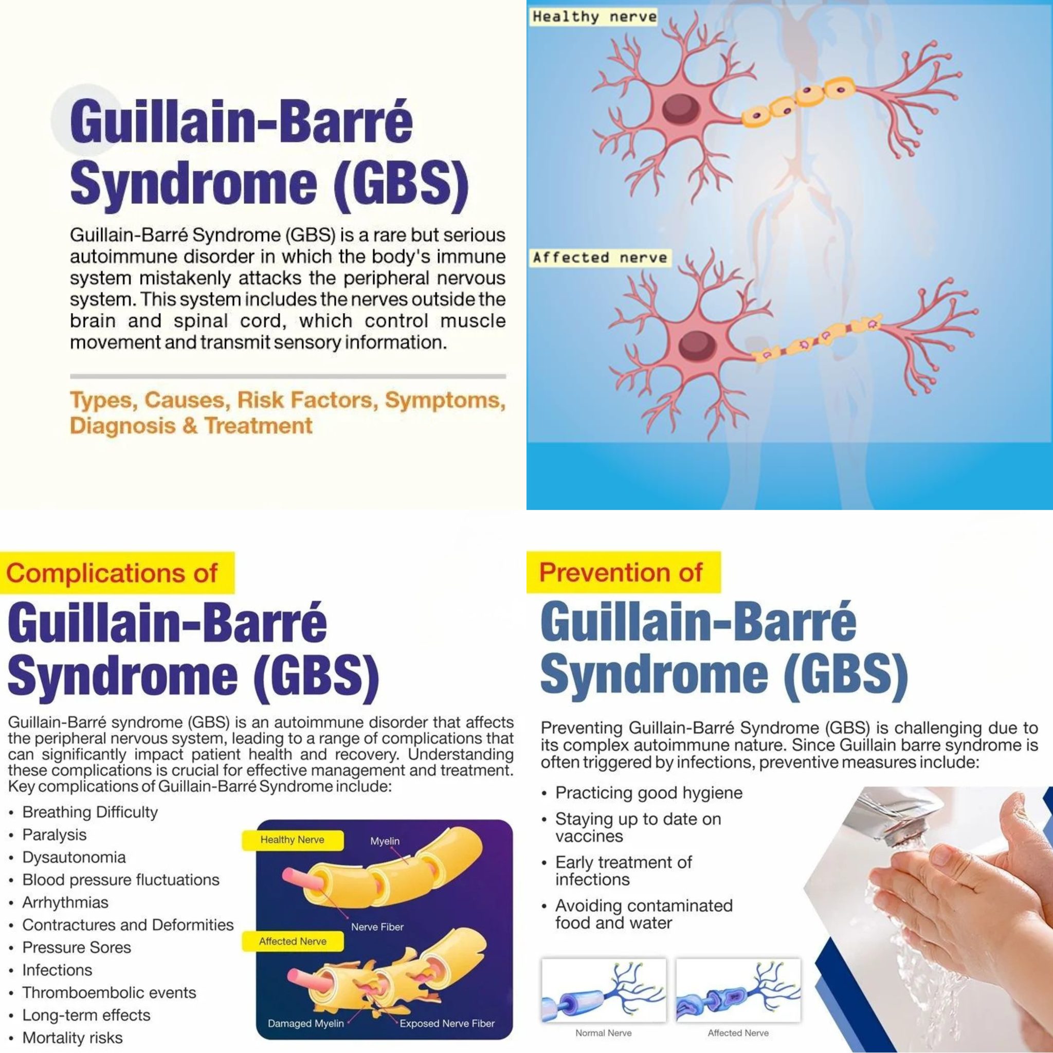 Guillain-Barré Syndrome (GBS) is an #autoimmune disease where the immune system attacks peripheral #nerves, causing weakness, tingling in the hands and feet and sometimes paralysis. To learn more about #GBS and its