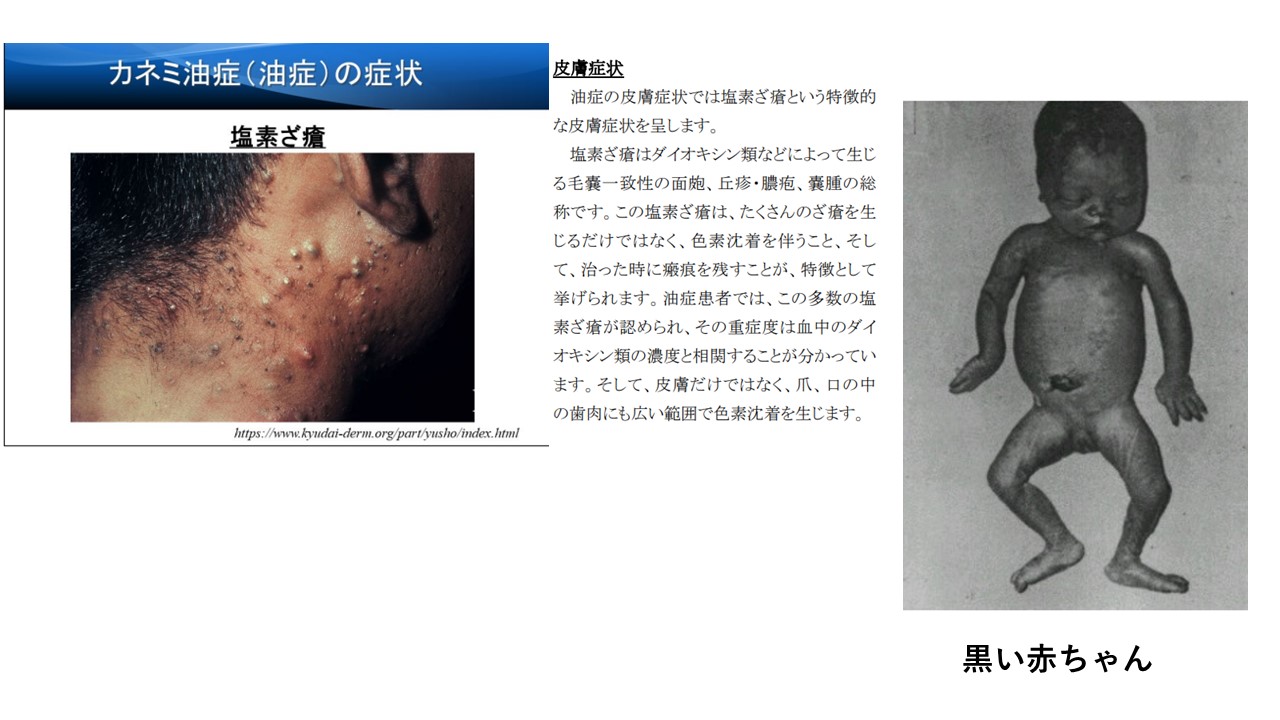 カネミ油症 症状 写真