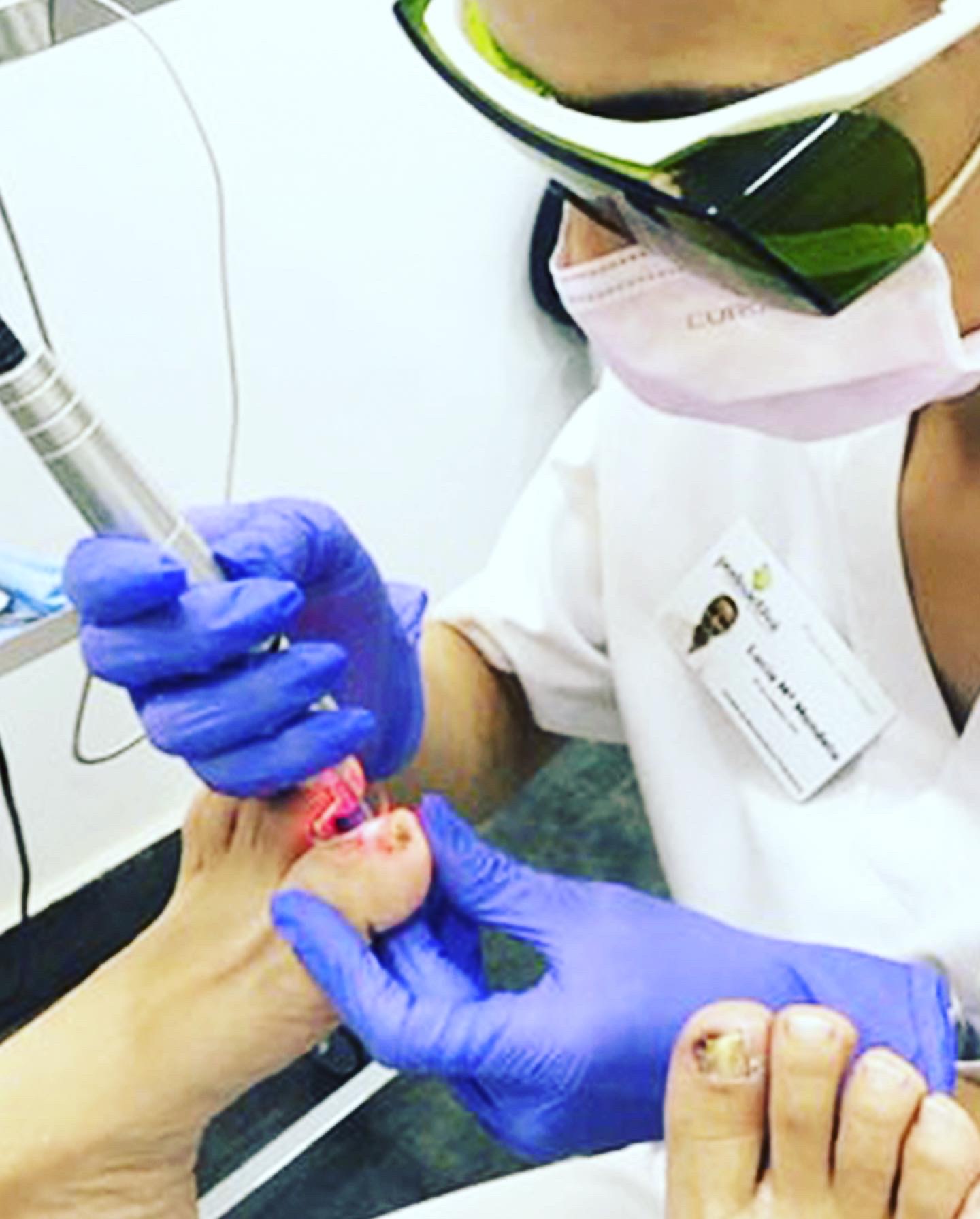 Schimmel-en Kalknagels Laserbehandeling PinPointe | Knokke-Heist